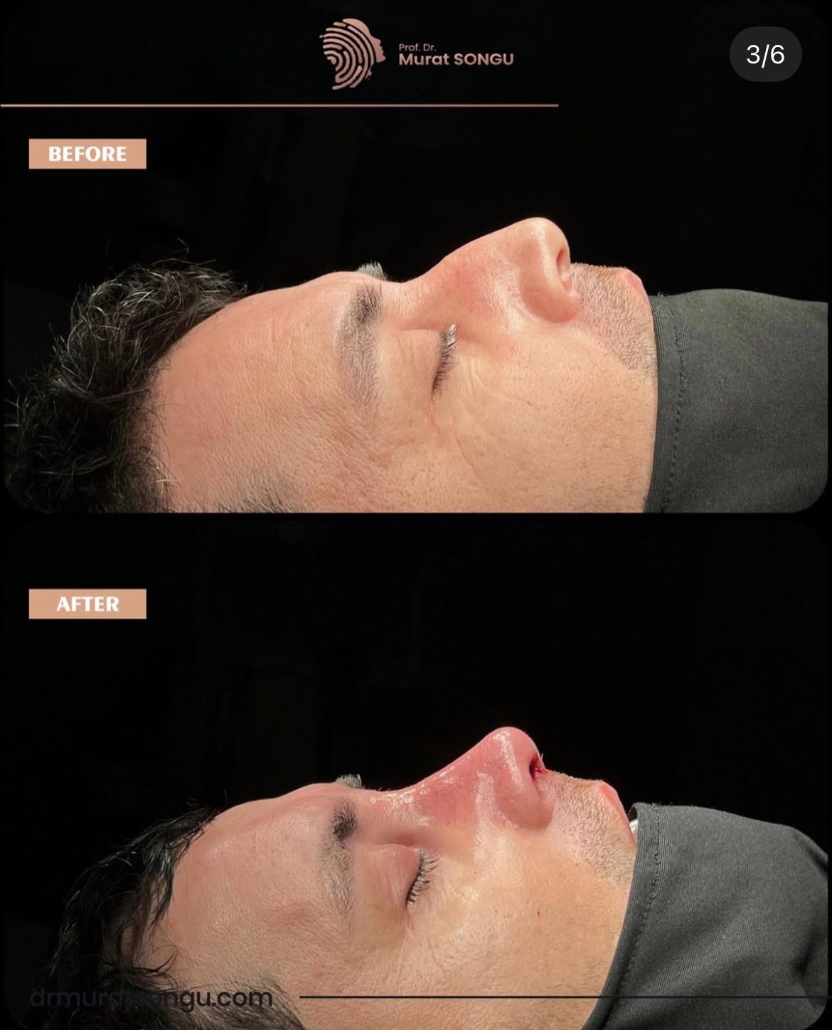 Male Rhinoplasty Before and After Photos