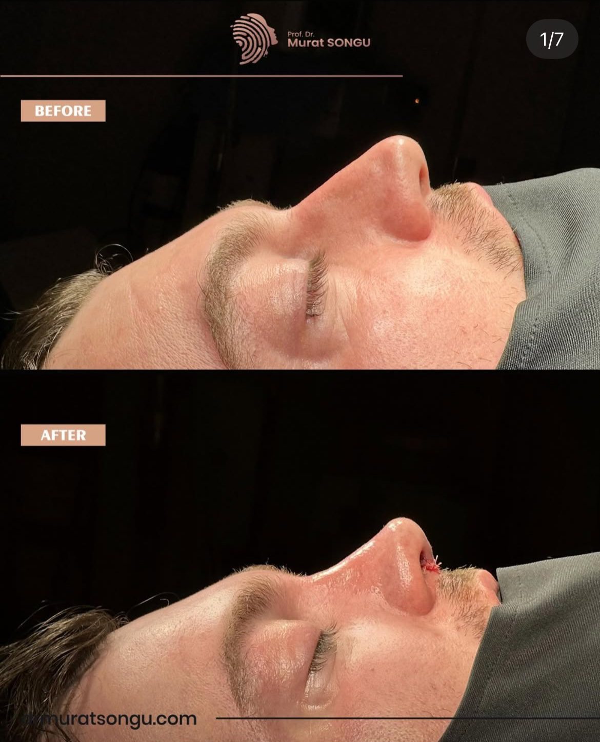 Male Rhinoplasty Before and After Photos