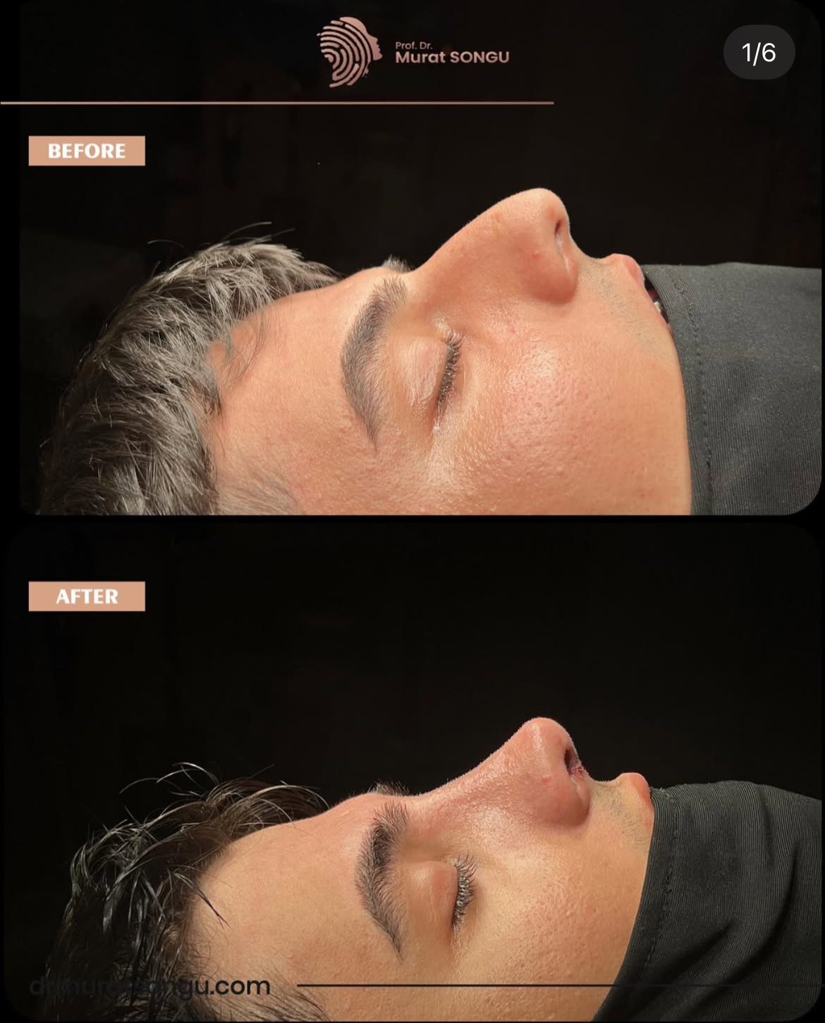Male Rhinoplasty Before and After Photos