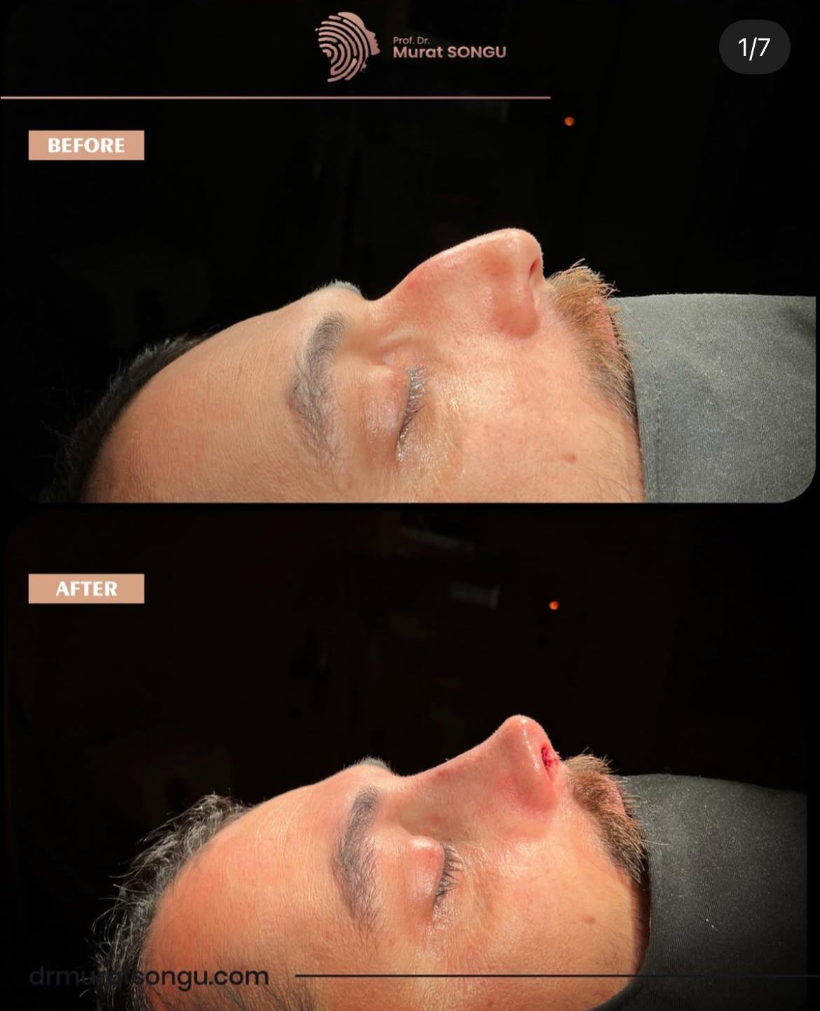 Male Rhinoplasty Before and After Photos