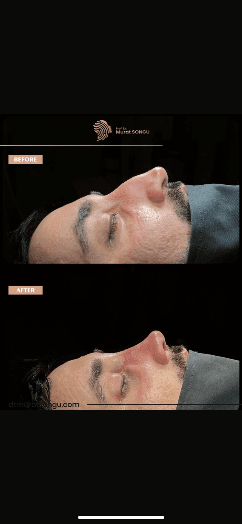 Male Rhinoplasty Before and After Photos