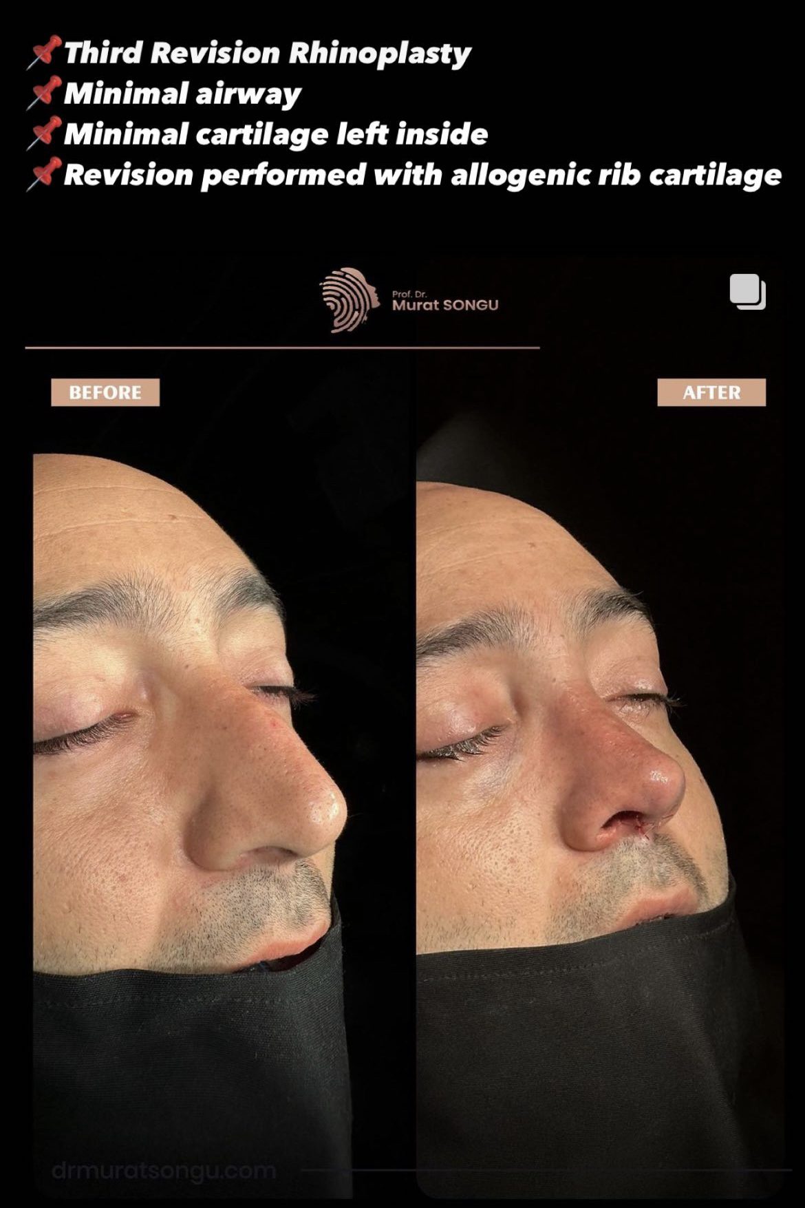 Male Rhinoplasty Before and After Photos