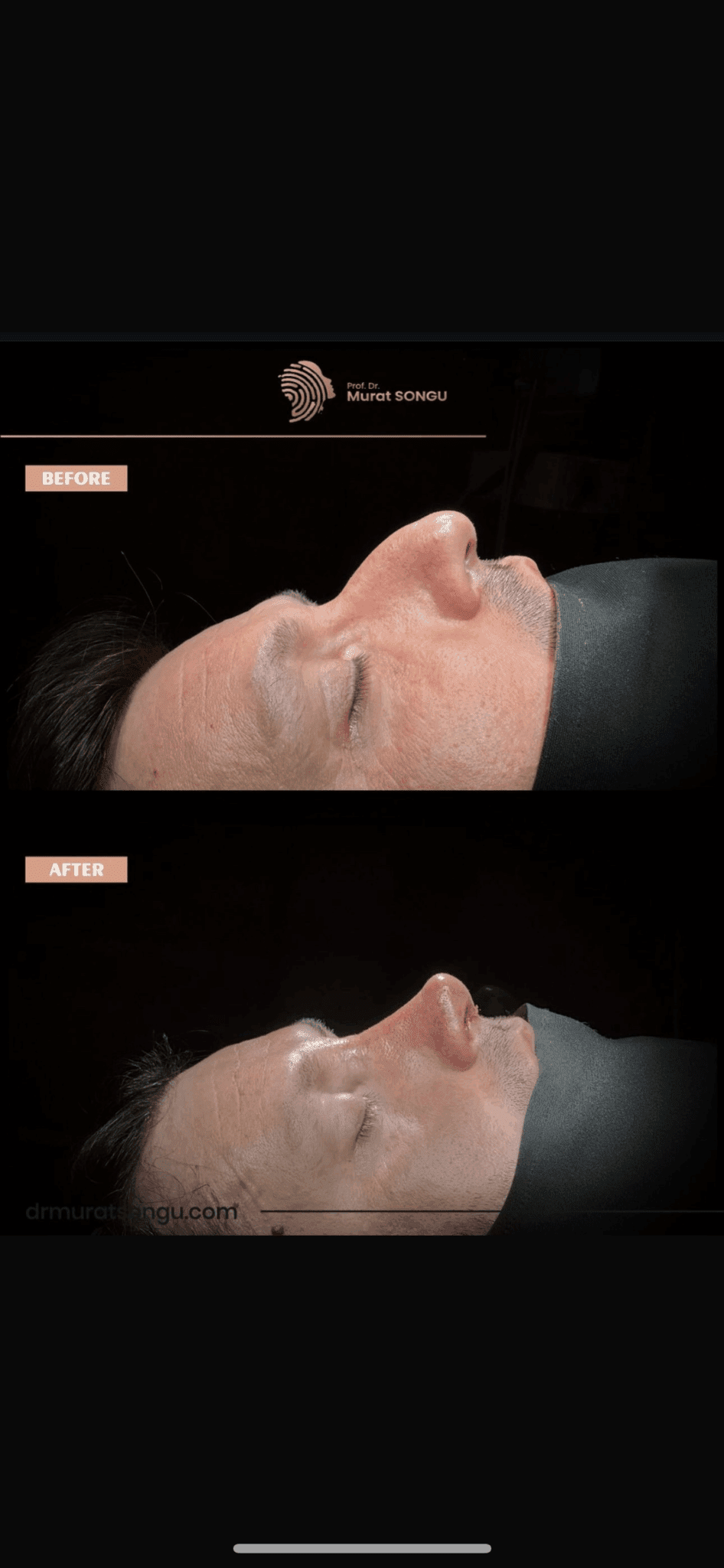 Male Rhinoplasty Before and After Photos
