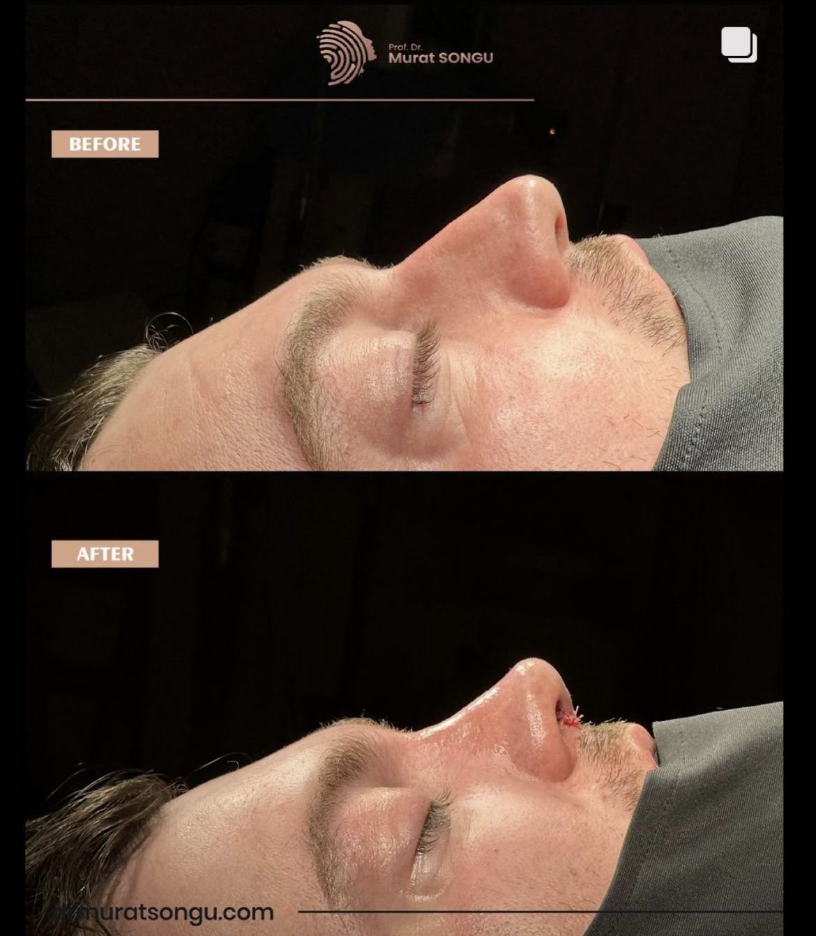 Male Rhinoplasty Before and After Photos