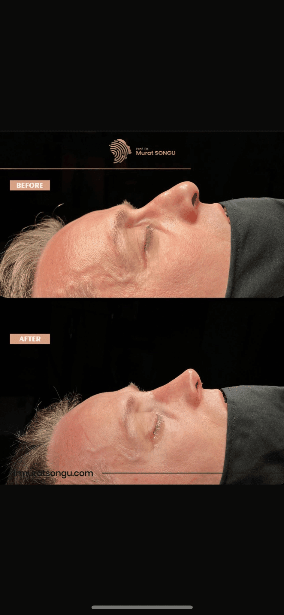 Male Rhinoplasty Before and After Photos