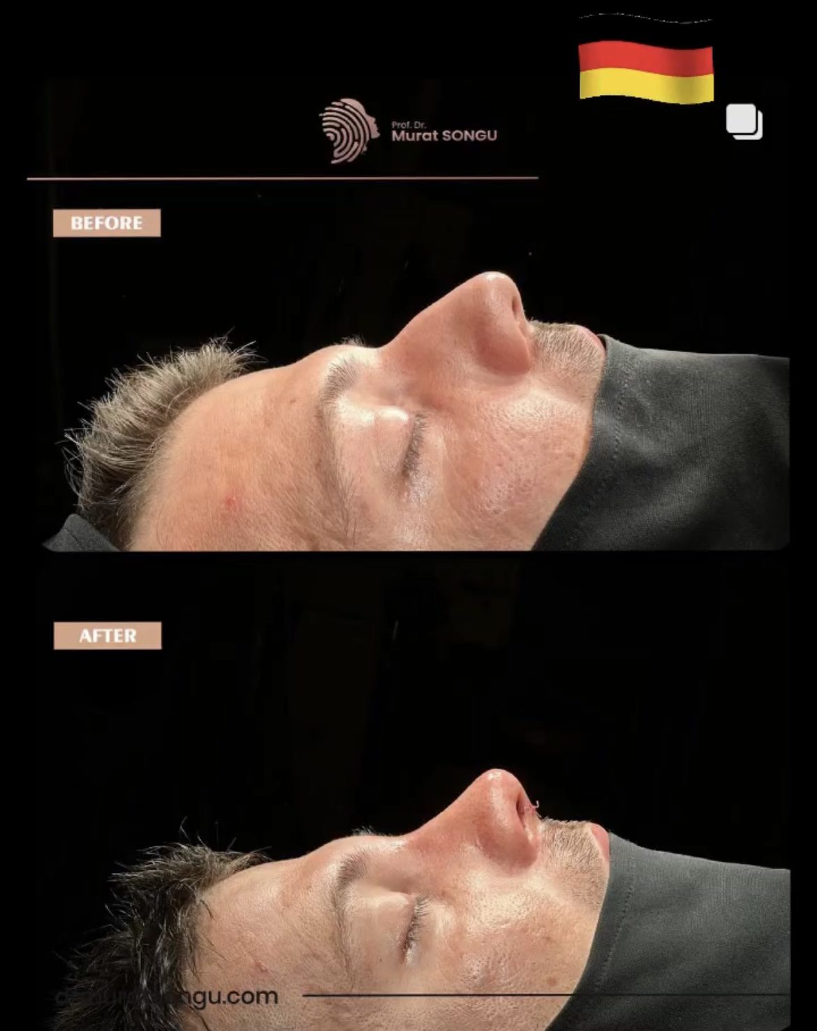Male Rhinoplasty Before and After Photos