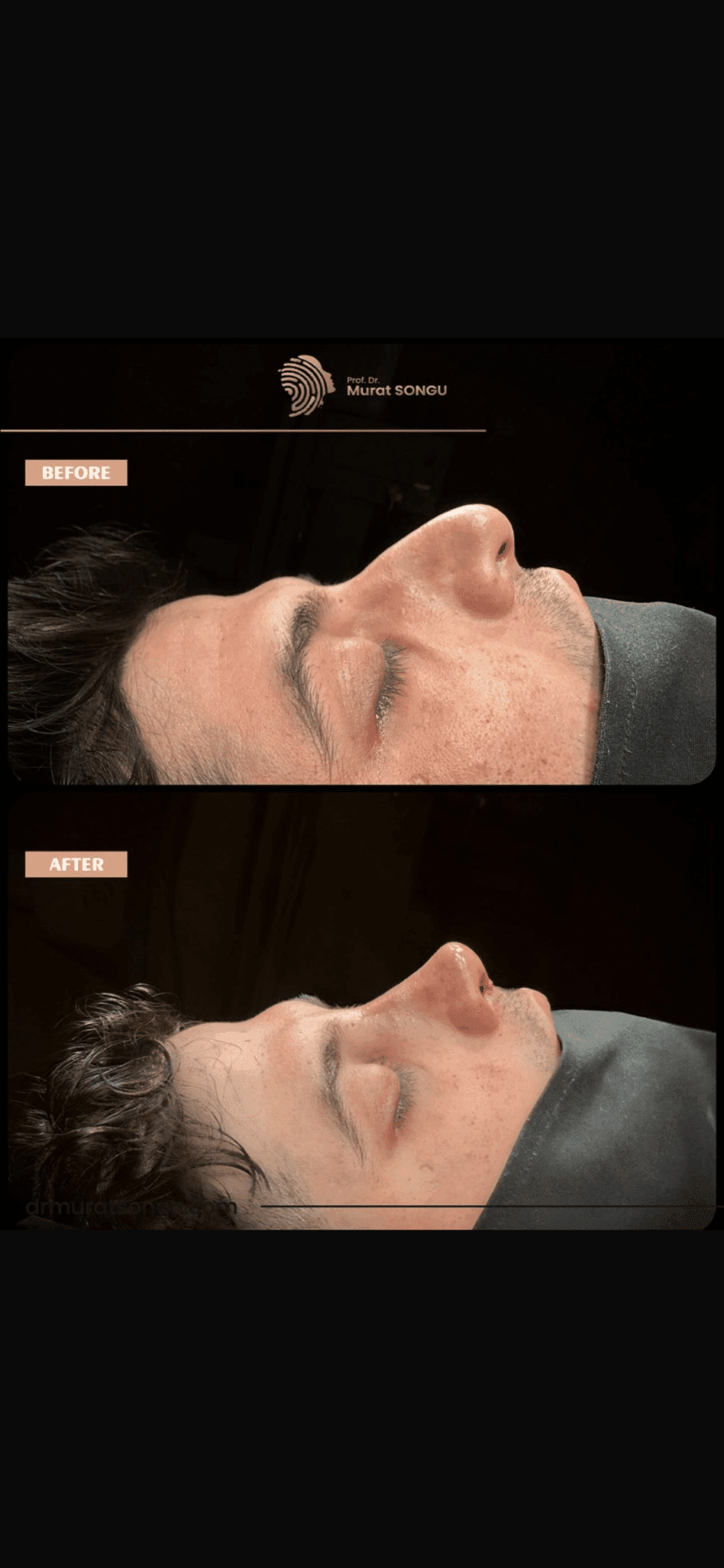 Male Rhinoplasty Before and After Photos