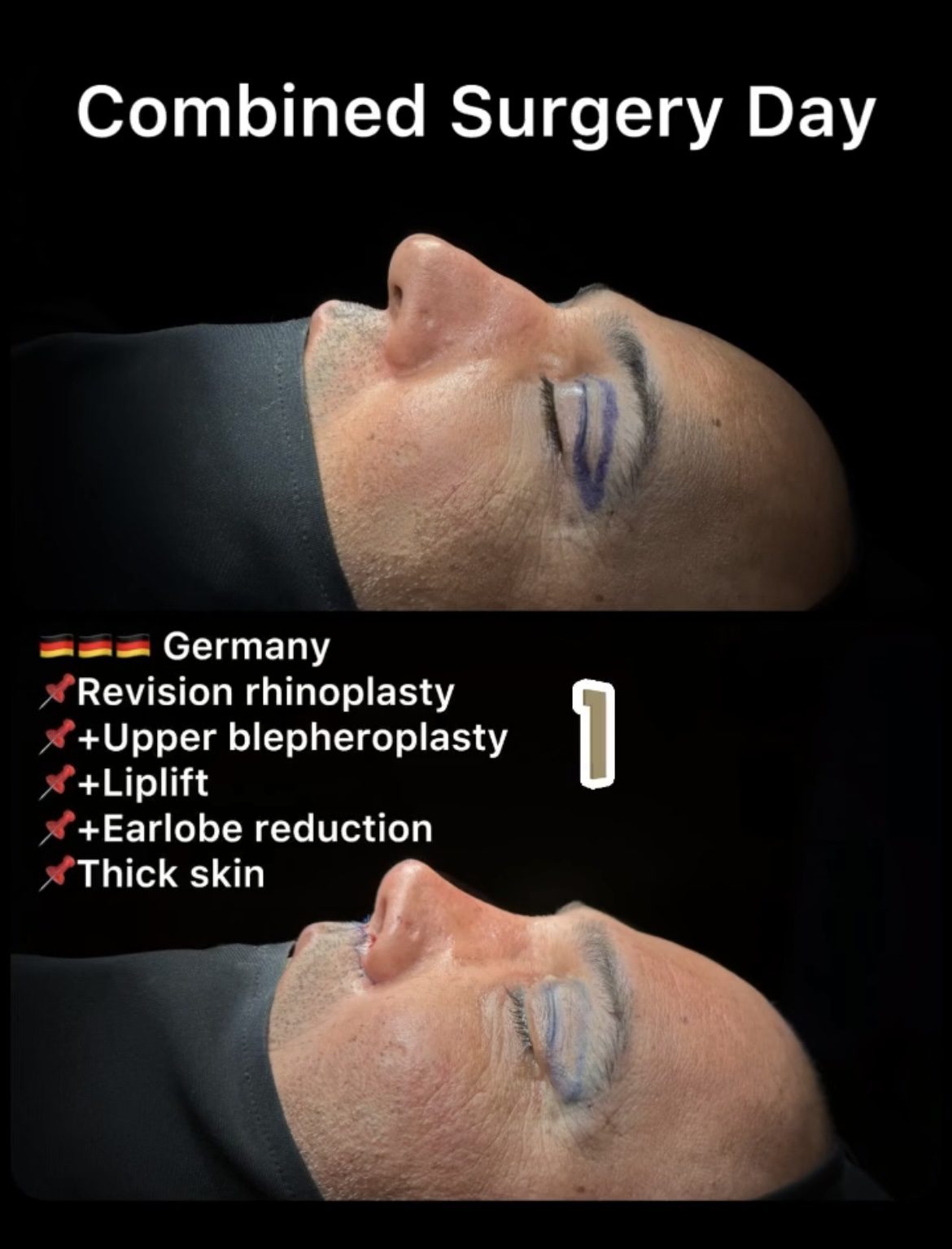 Male Rhinoplasty Before and After Photos