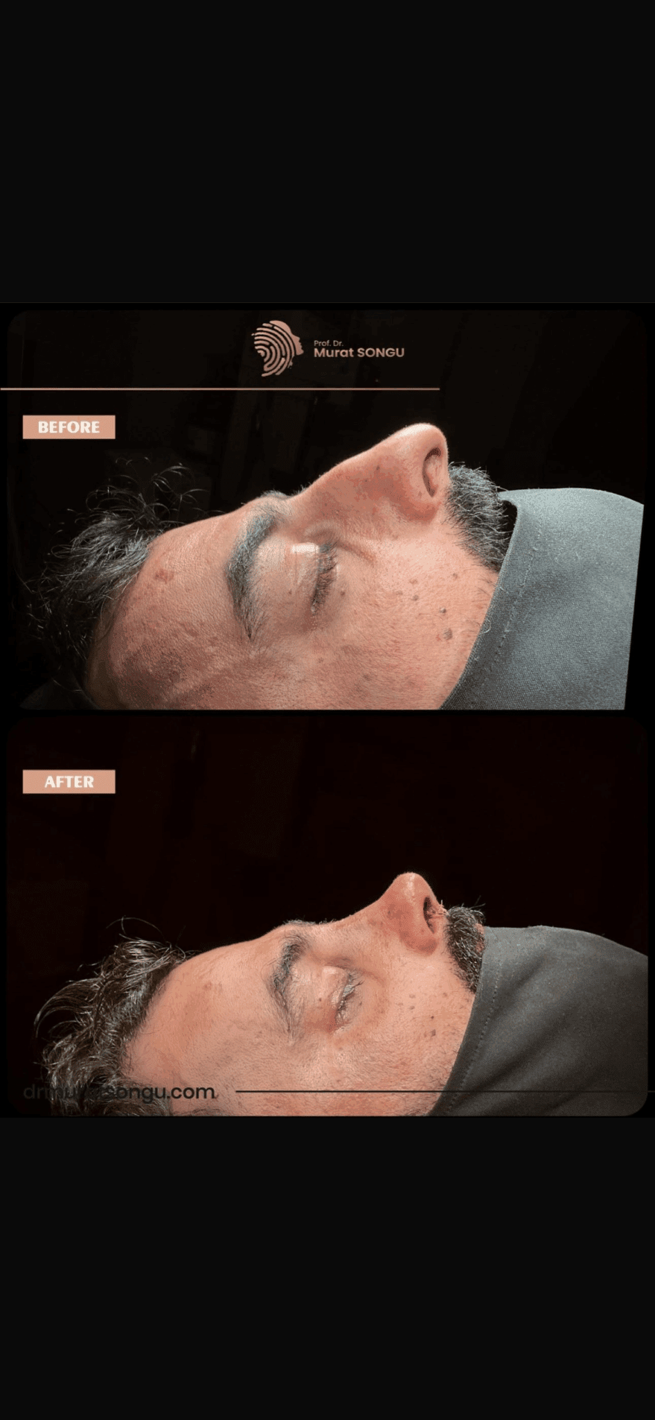 Male Rhinoplasty Before and After Photos