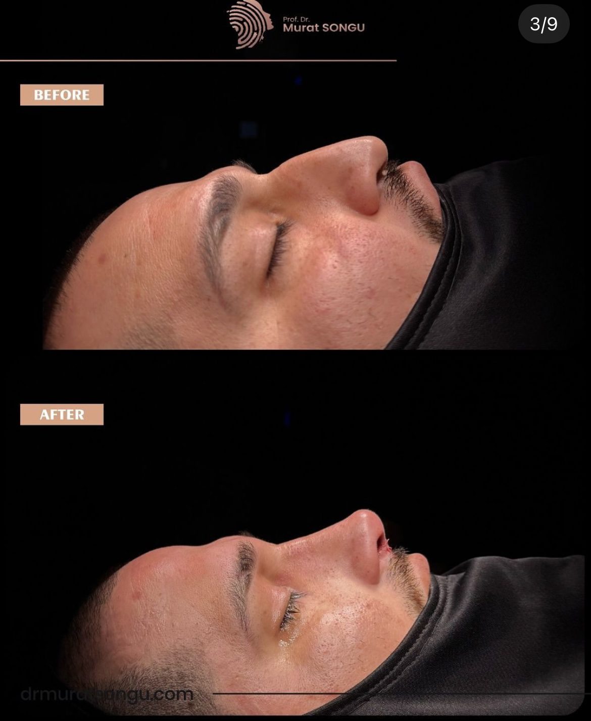 Male Rhinoplasty Before and After Photos