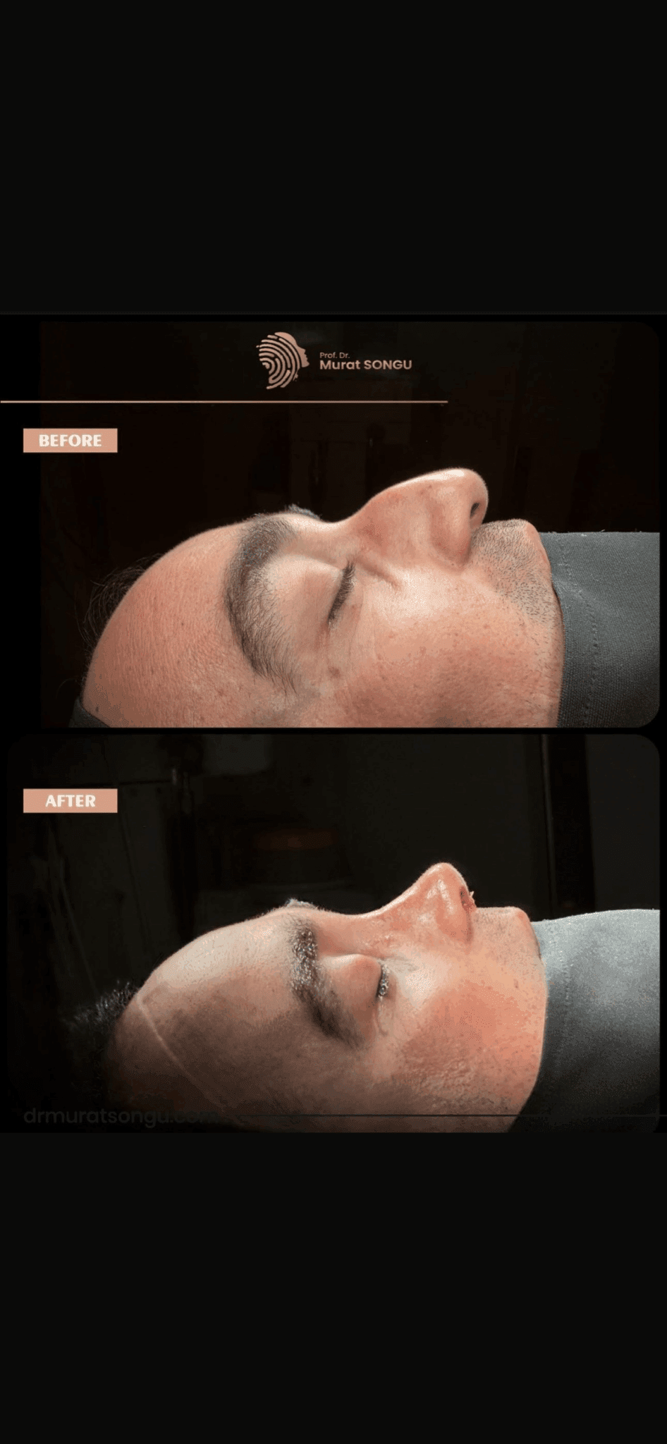Male Rhinoplasty Before and After Photos