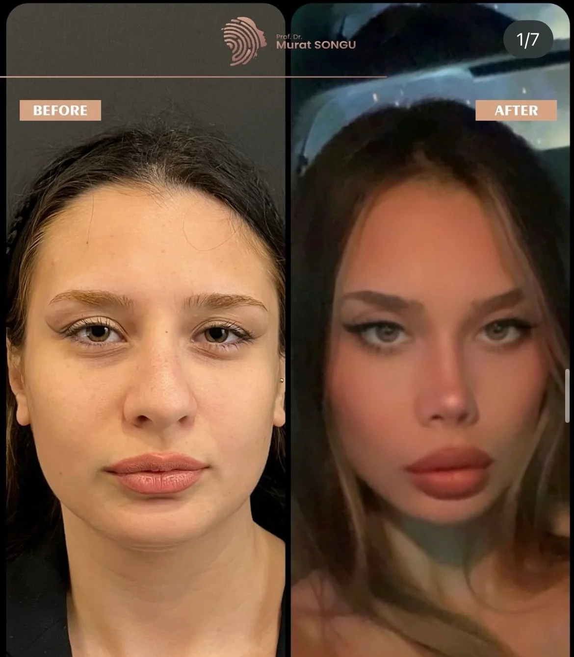 Neseoperasjon Før & Etter Neseoperasjon Før & Etter