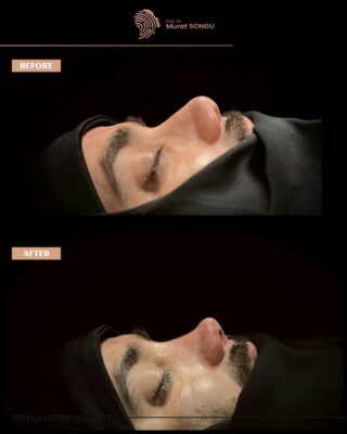 Nubian Nose Rhinoplasty Result side view