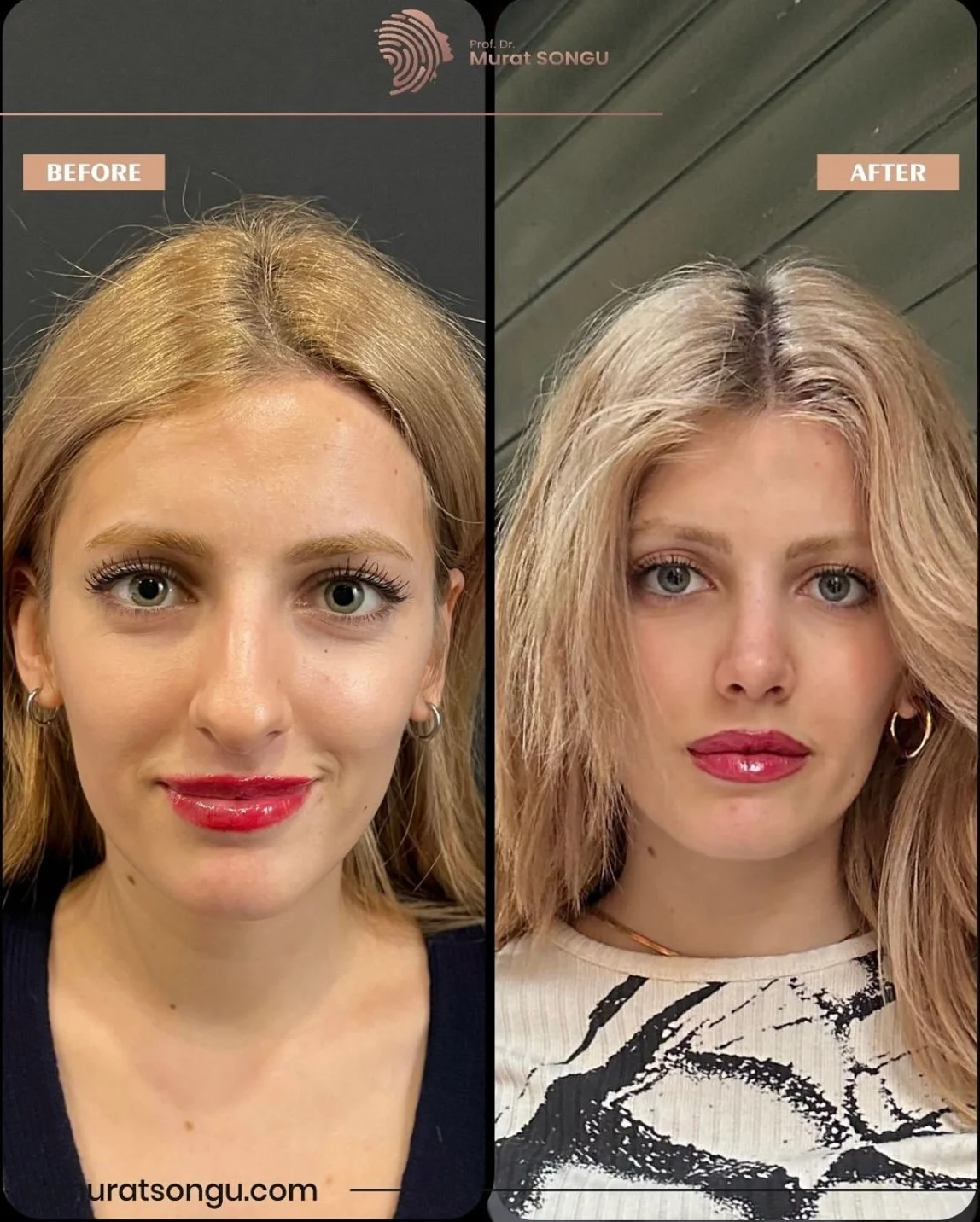 Plastyczna Nosa Przed i Po Plastyczna Nosa Przed i Po