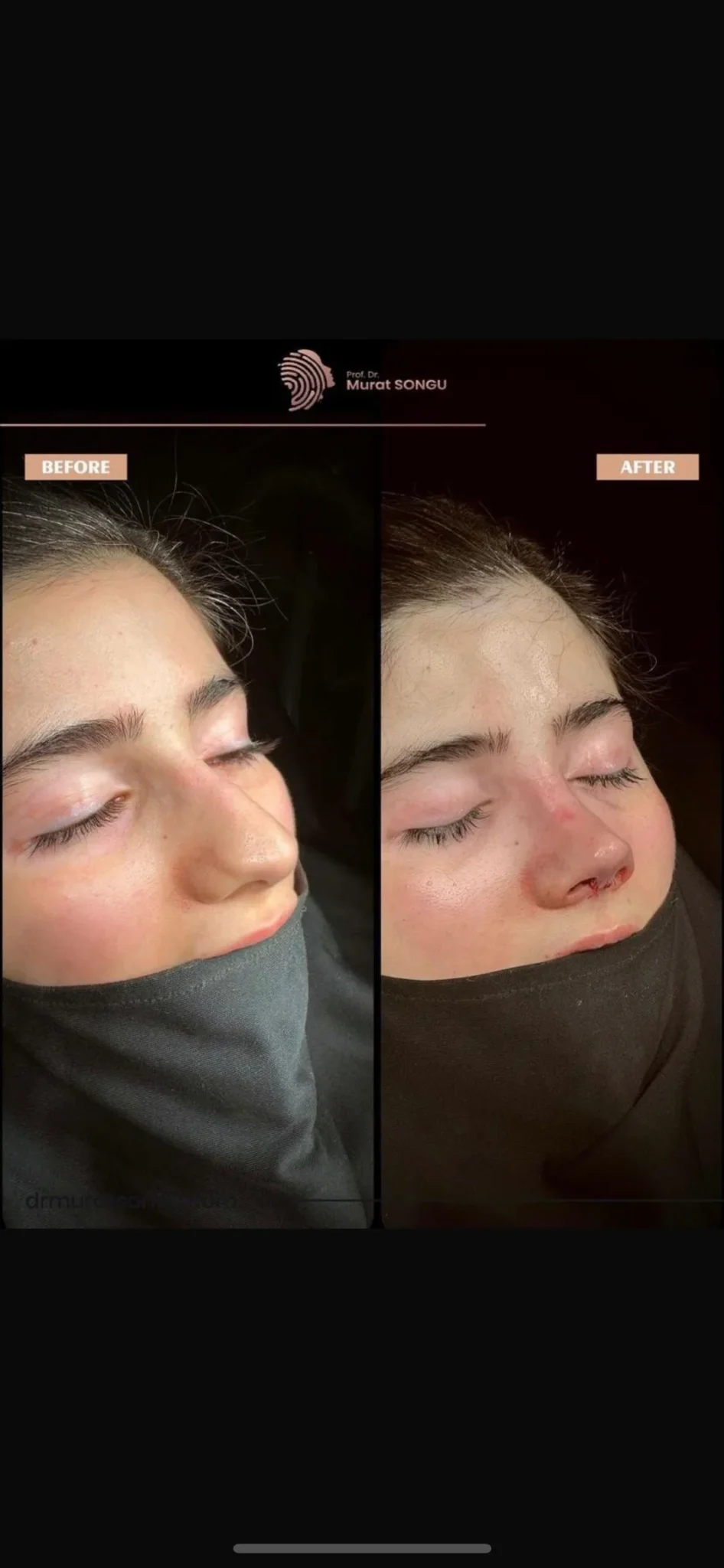 Revision Næseoperation Før & Efter