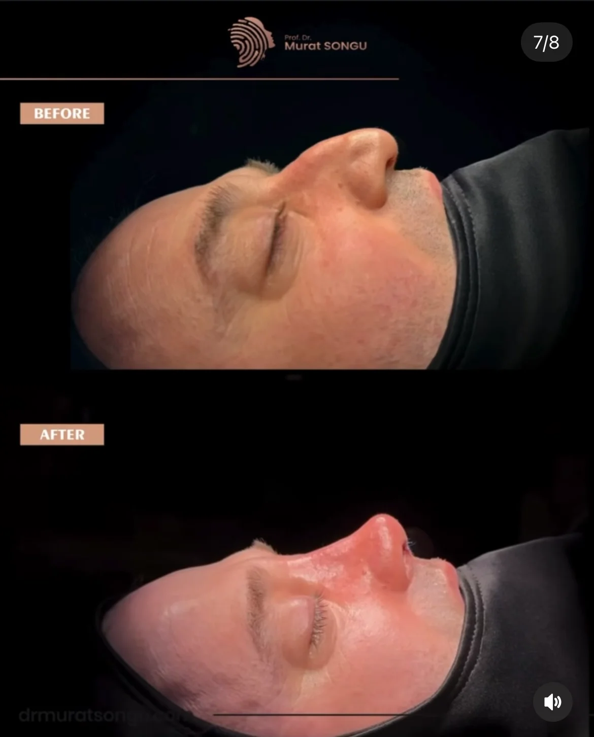 Revisionsrhinoplastik Före och Efter