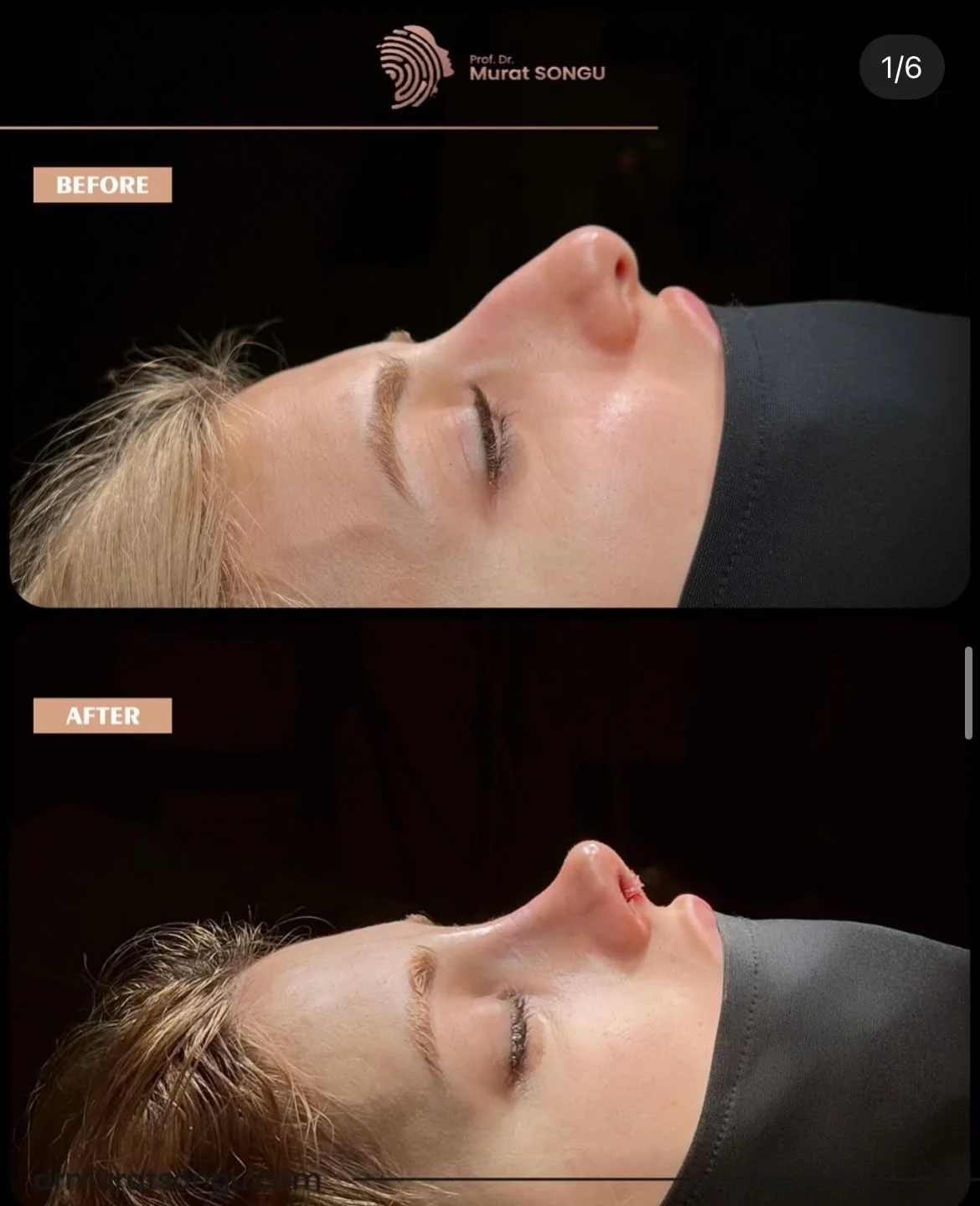 Revisionsrhinoplastik Före och Efter