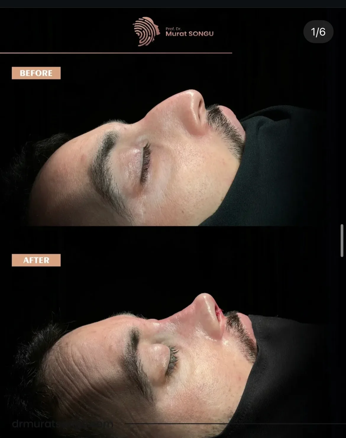 Rhinoplastie Peau Épaisse Avant & Après