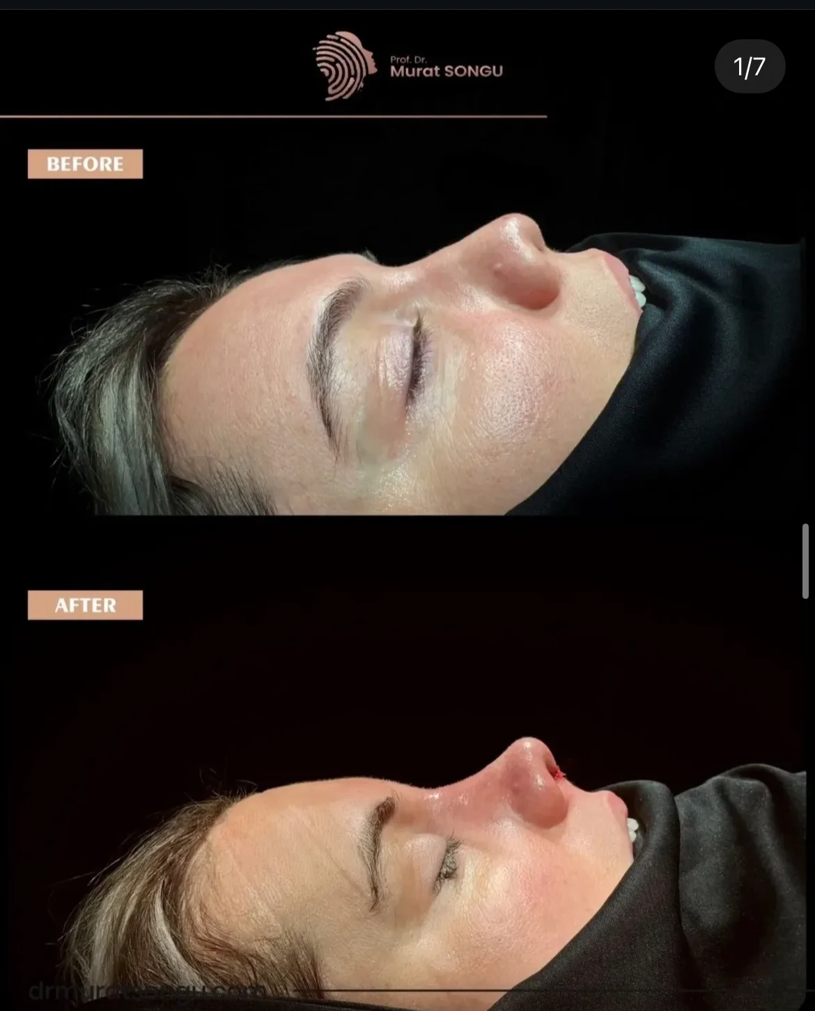 Rhinoplastie Peau Épaisse Avant & Après