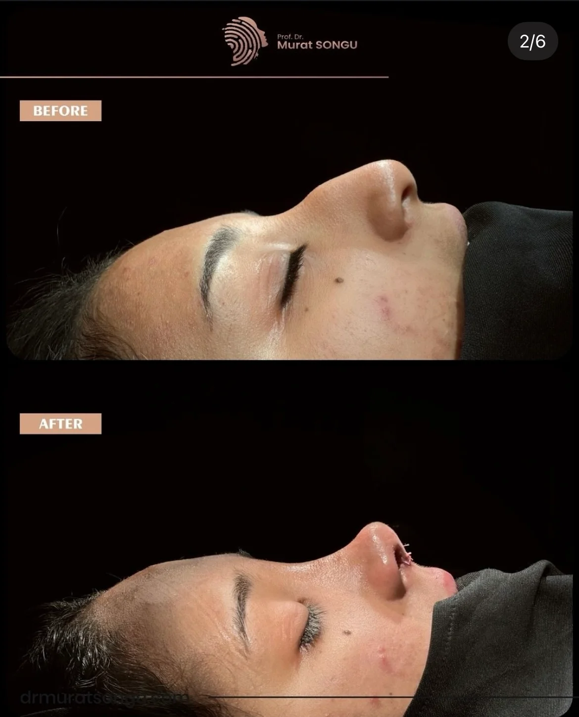 Rhinoplastie Peau Épaisse Avant & Après