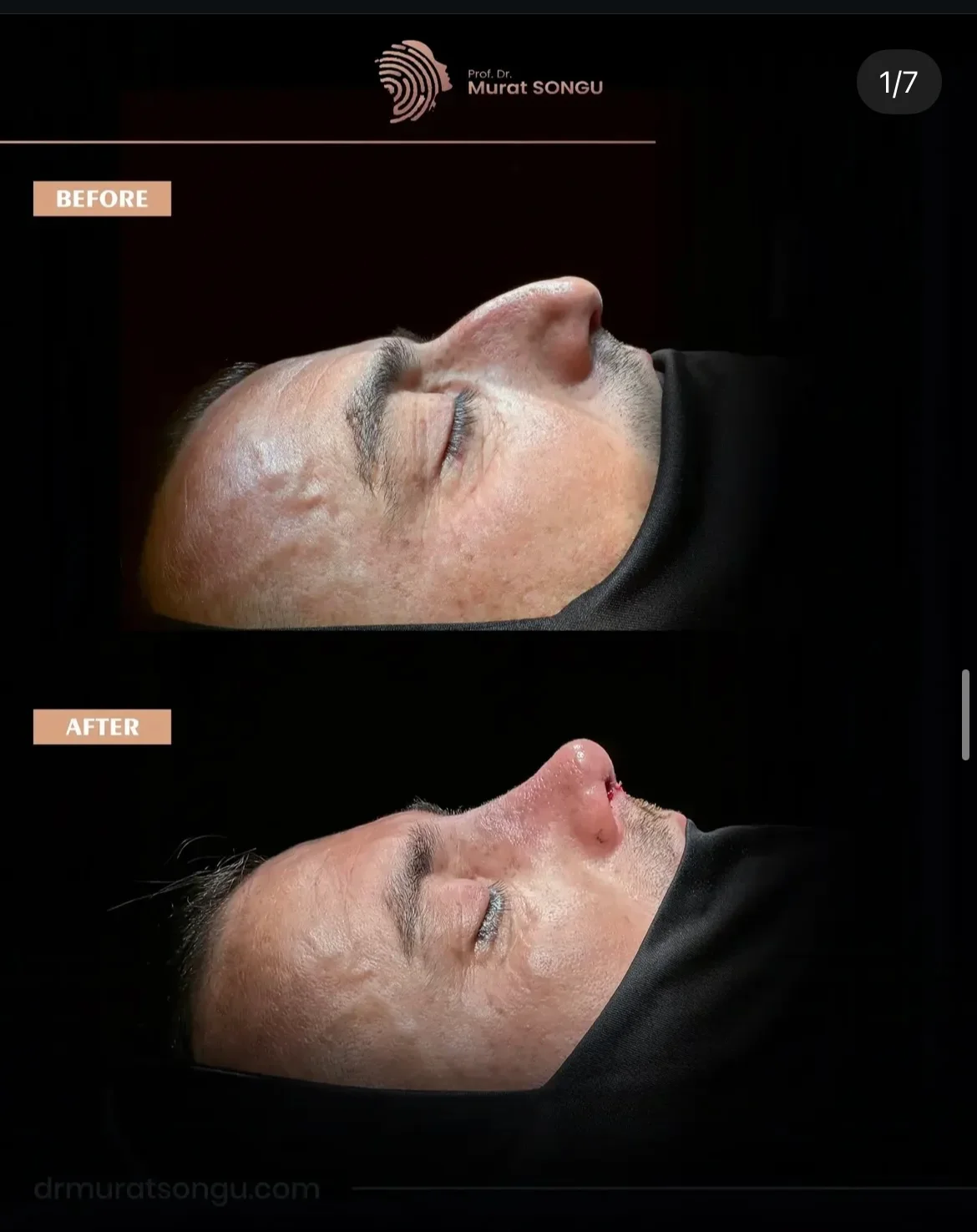 Rhinoplastie Peau Épaisse Avant & Après