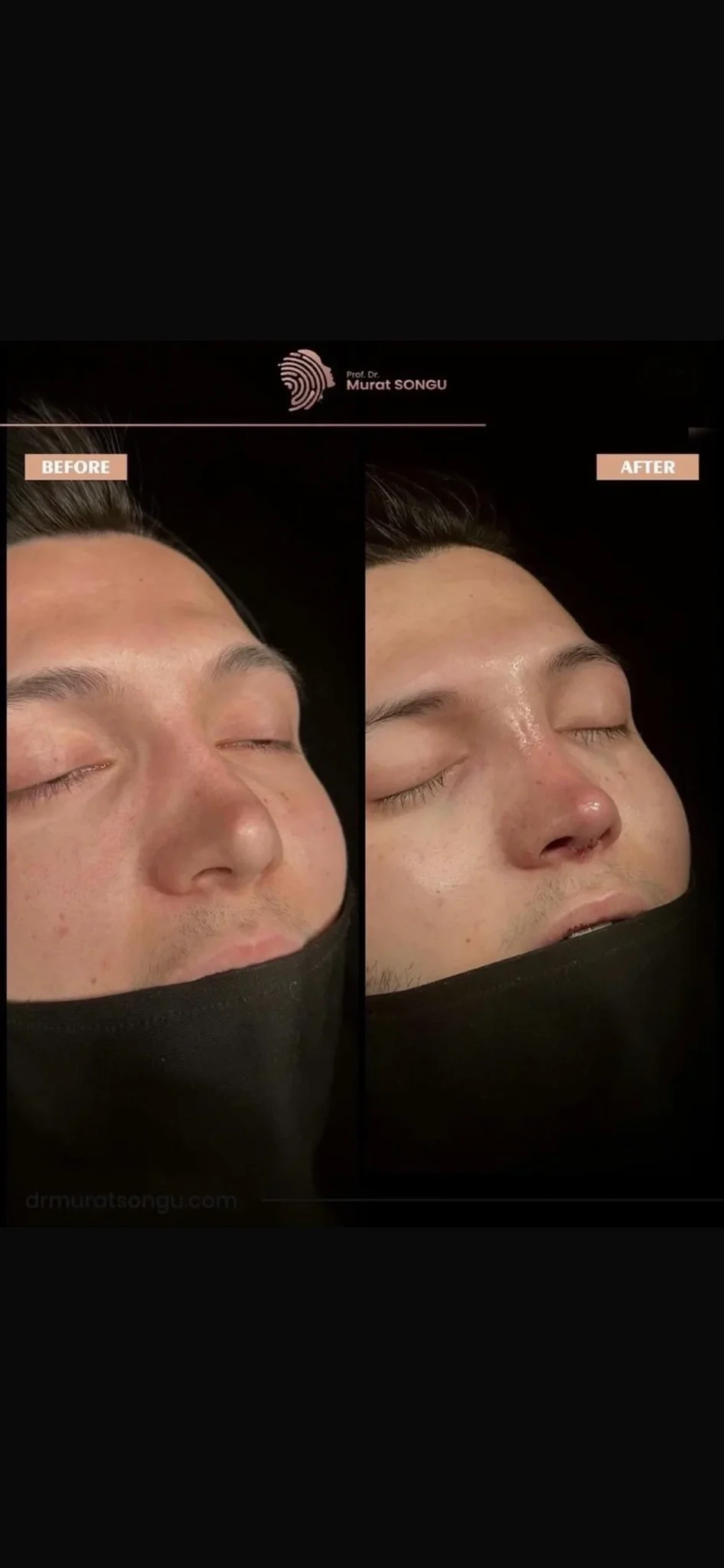 Rhinoplastie de Révision Avant & Après
