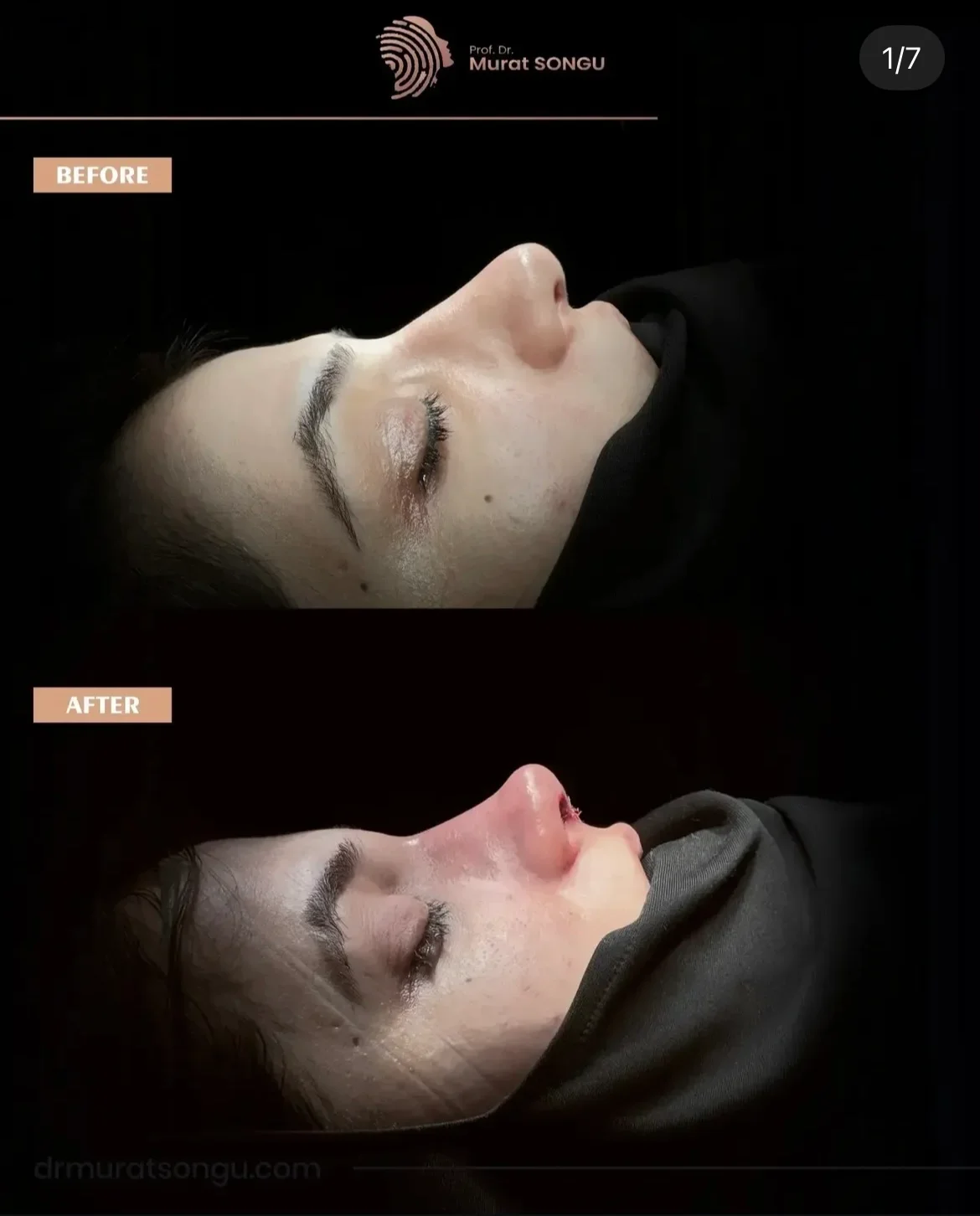 Rhinoplastie de Révision Avant & Après