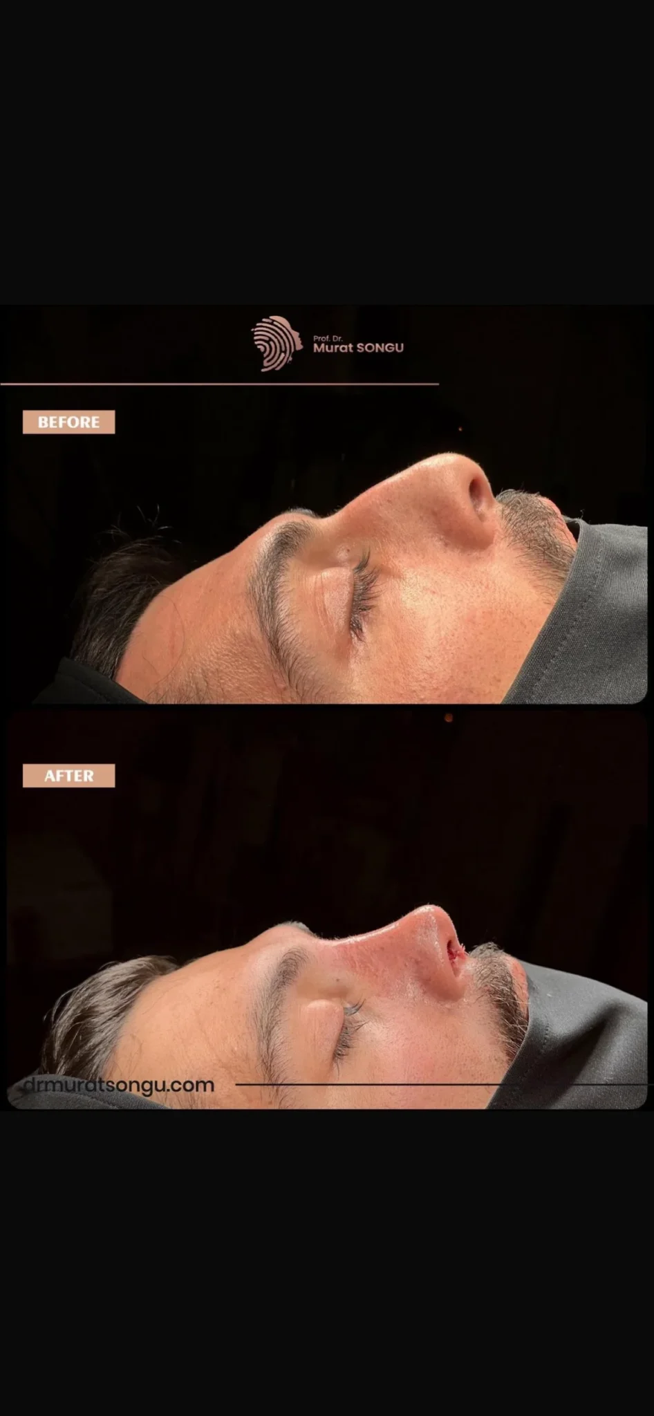 Rhinoplastie de Révision Avant & Après