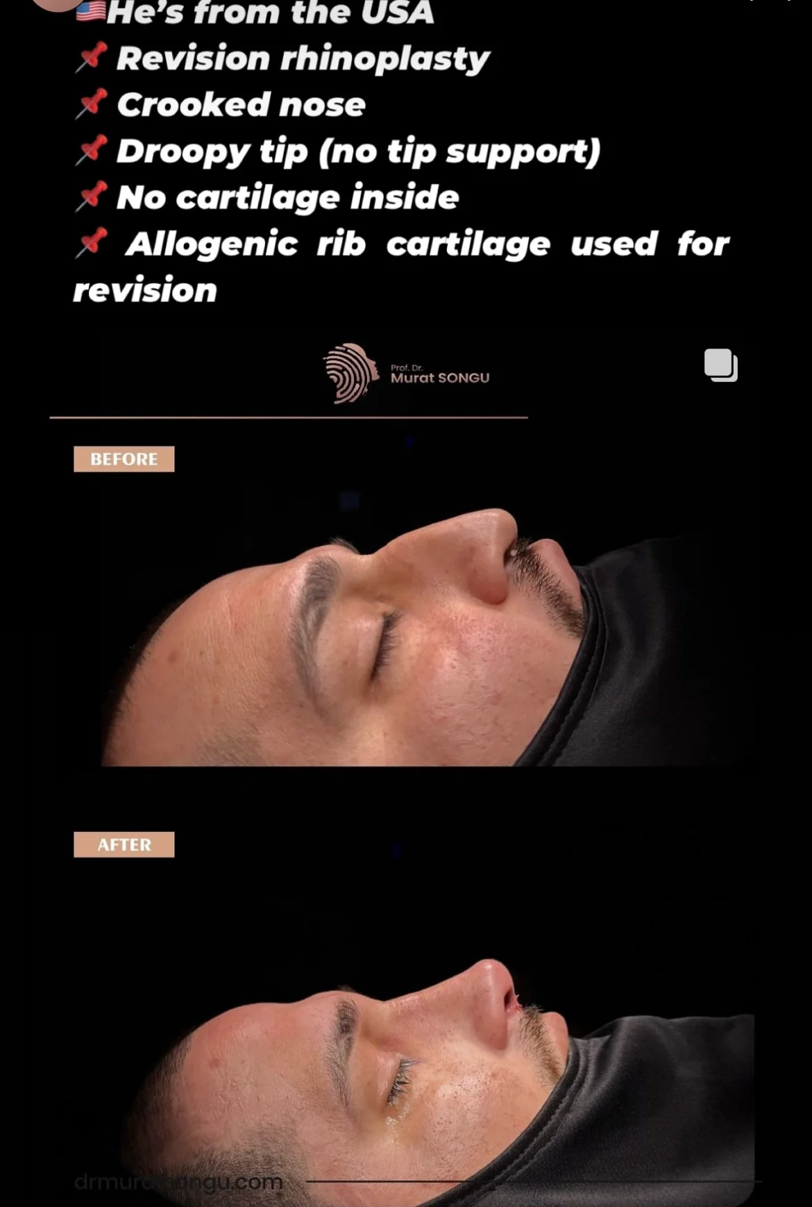 Rhinoplastie de Révision Avant & Après