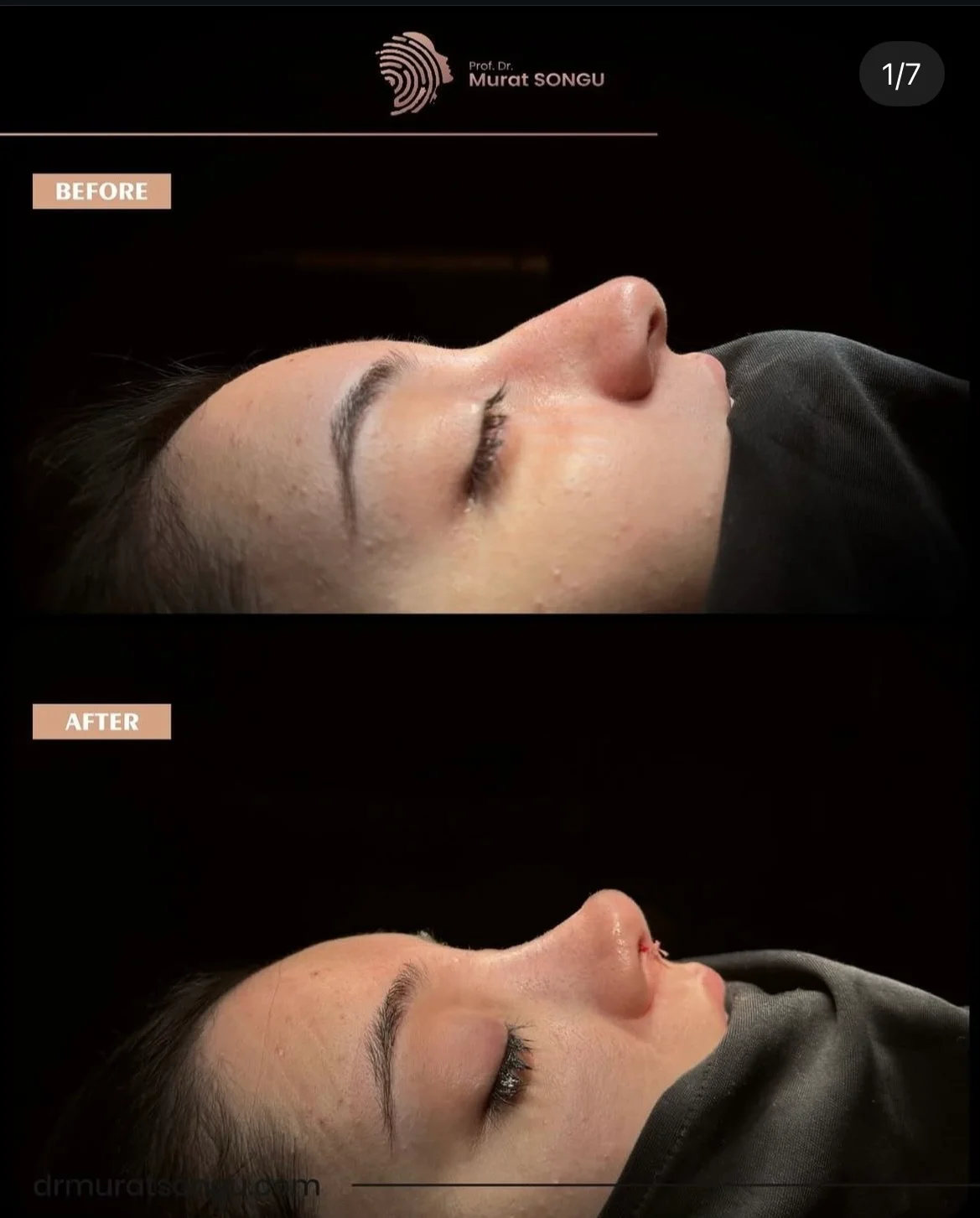 Rhinoplastiek Bij Dikke Huid Voor en Na