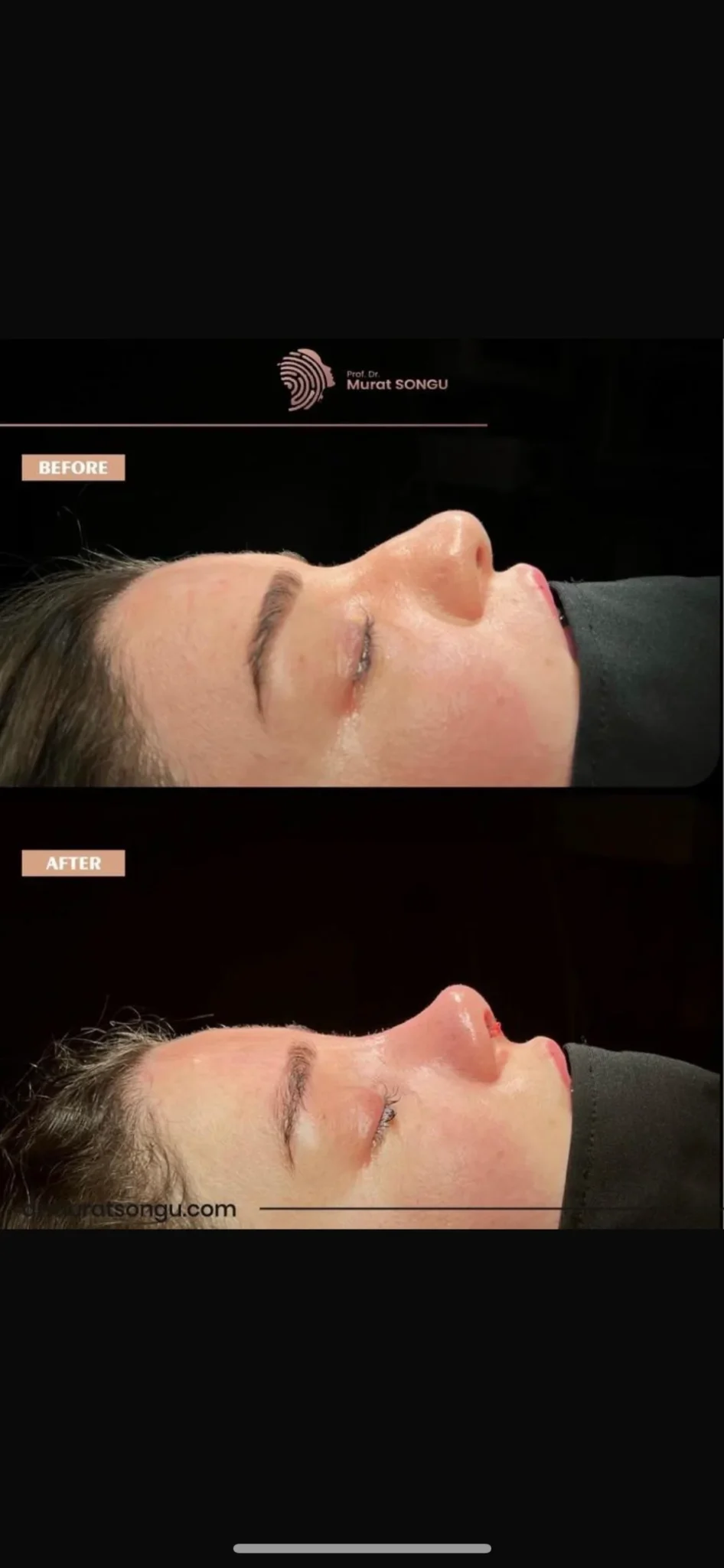 Rhinoplastiek Bij Dikke Huid Voor en Na