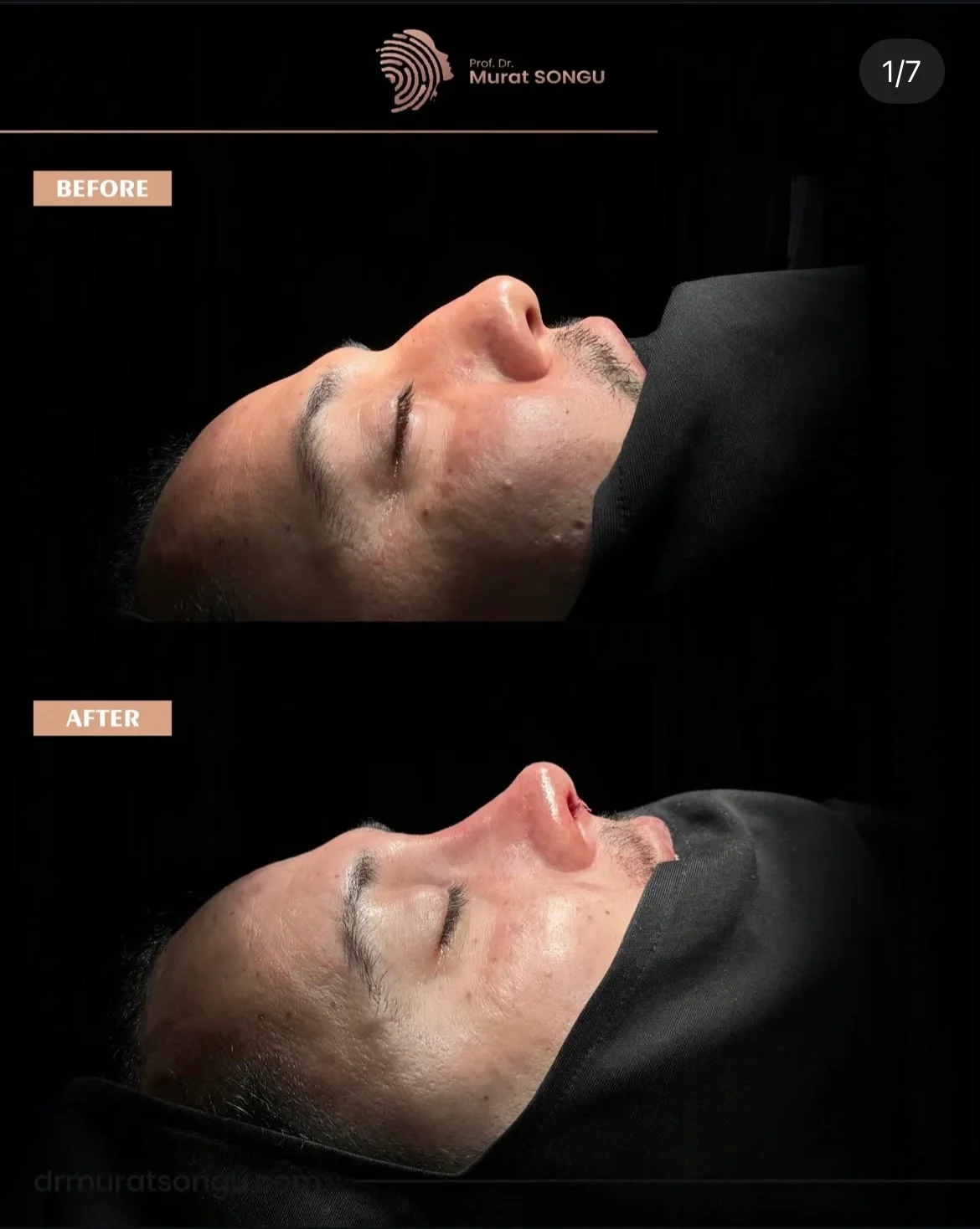 Rhinoplastiek Bij Dikke Huid Voor en Na