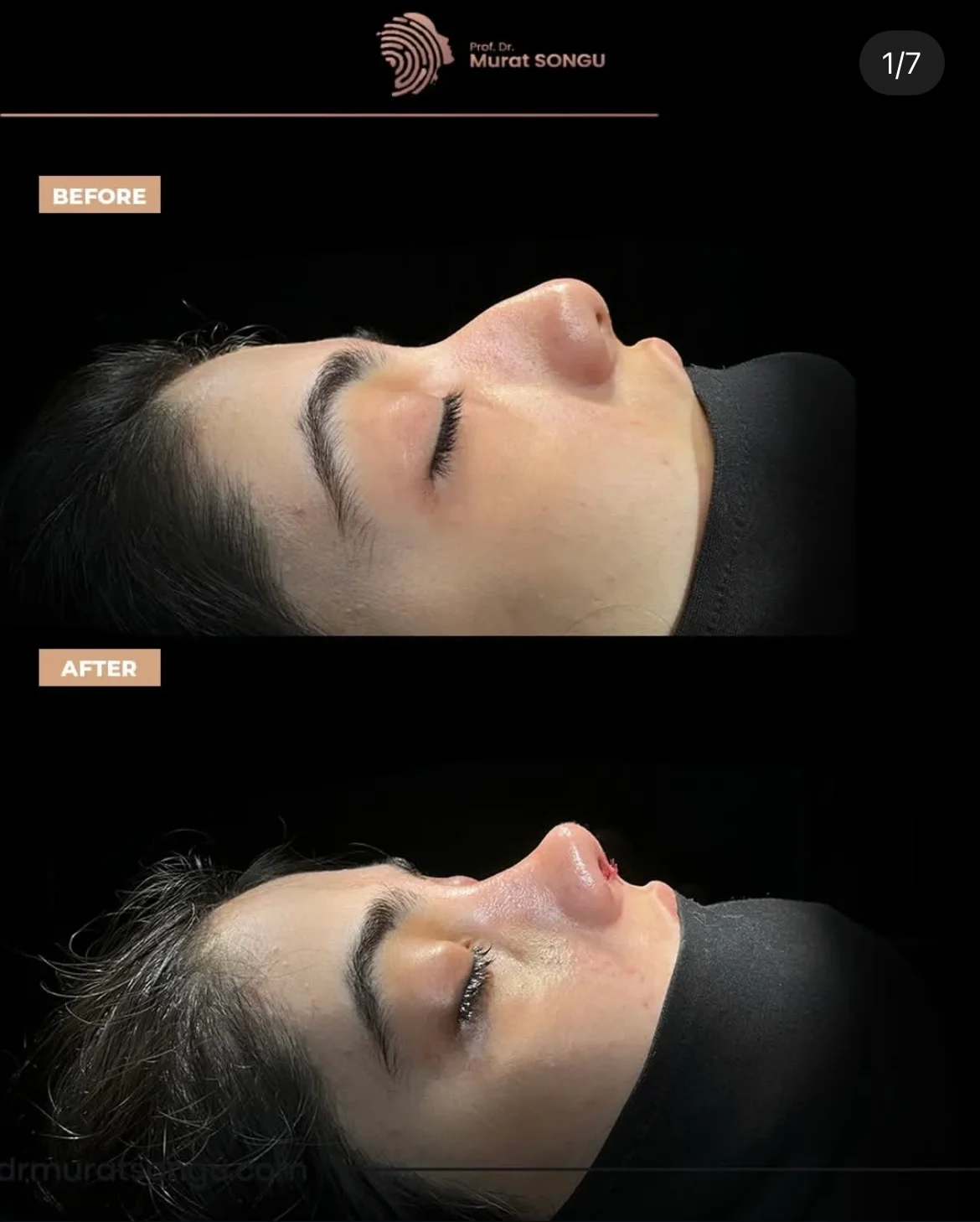 Rhinoplastiek Bij Dikke Huid Voor en Na