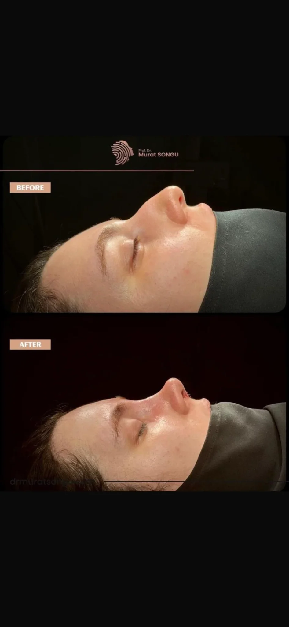 Rhinoplastiek Bij Dikke Huid Voor en Na