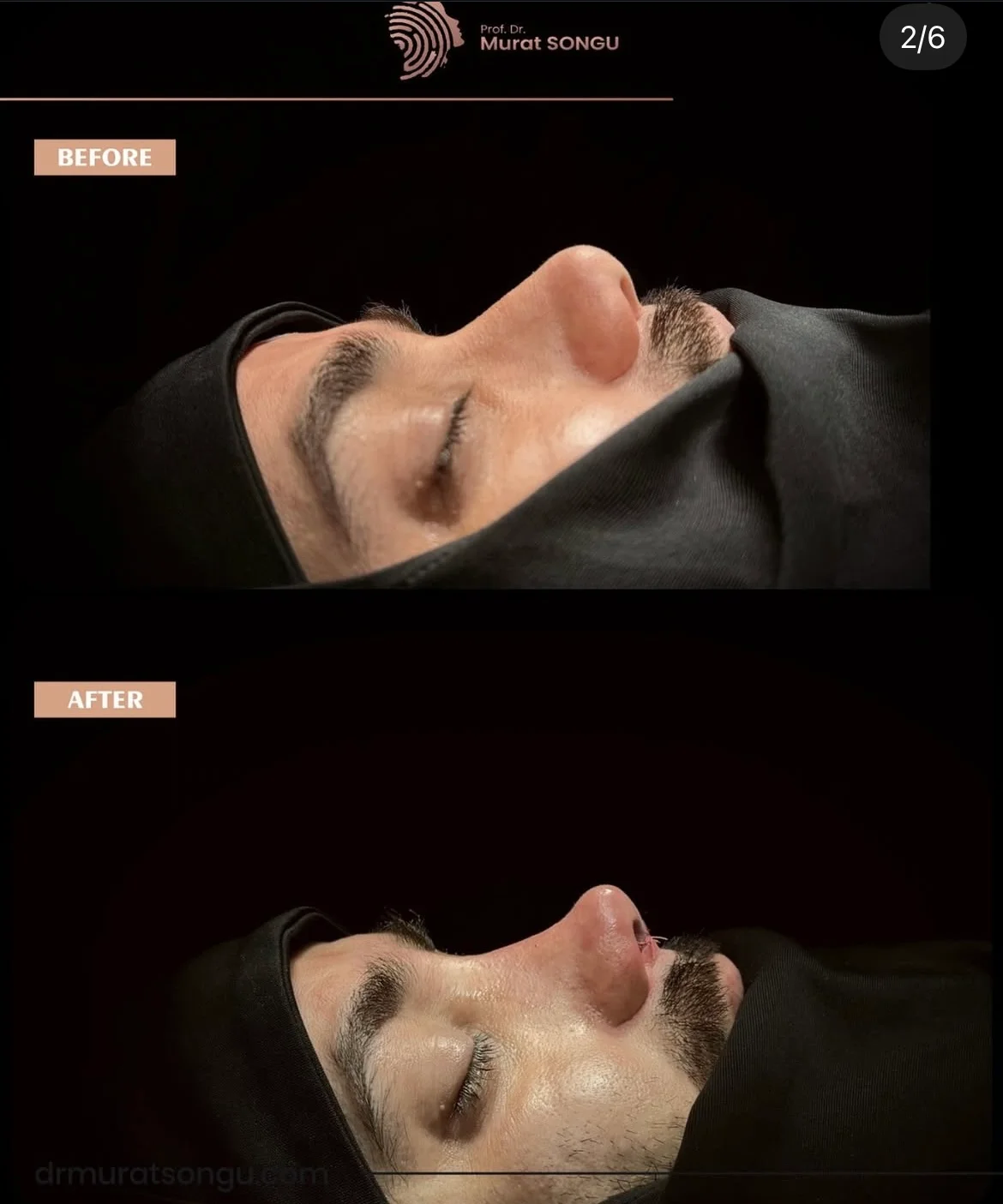 Rhinoplastiek Bij Dikke Huid Voor en Na