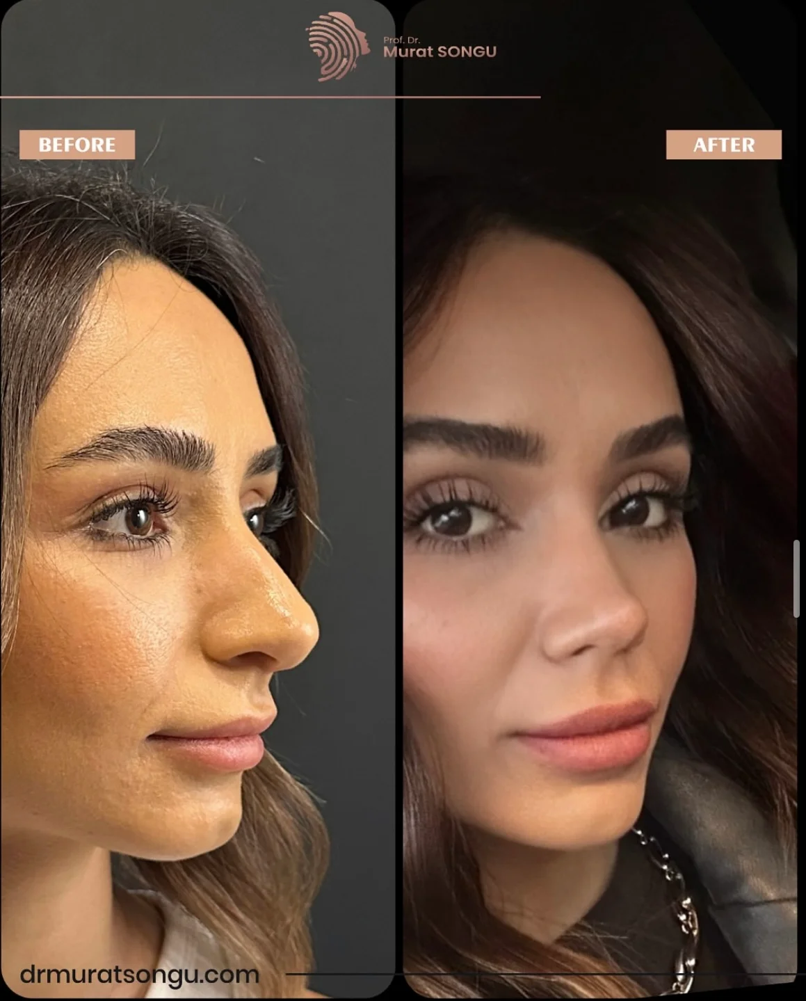 Rhinoplastik Före och Efter Rhinoplastik Före och Efter