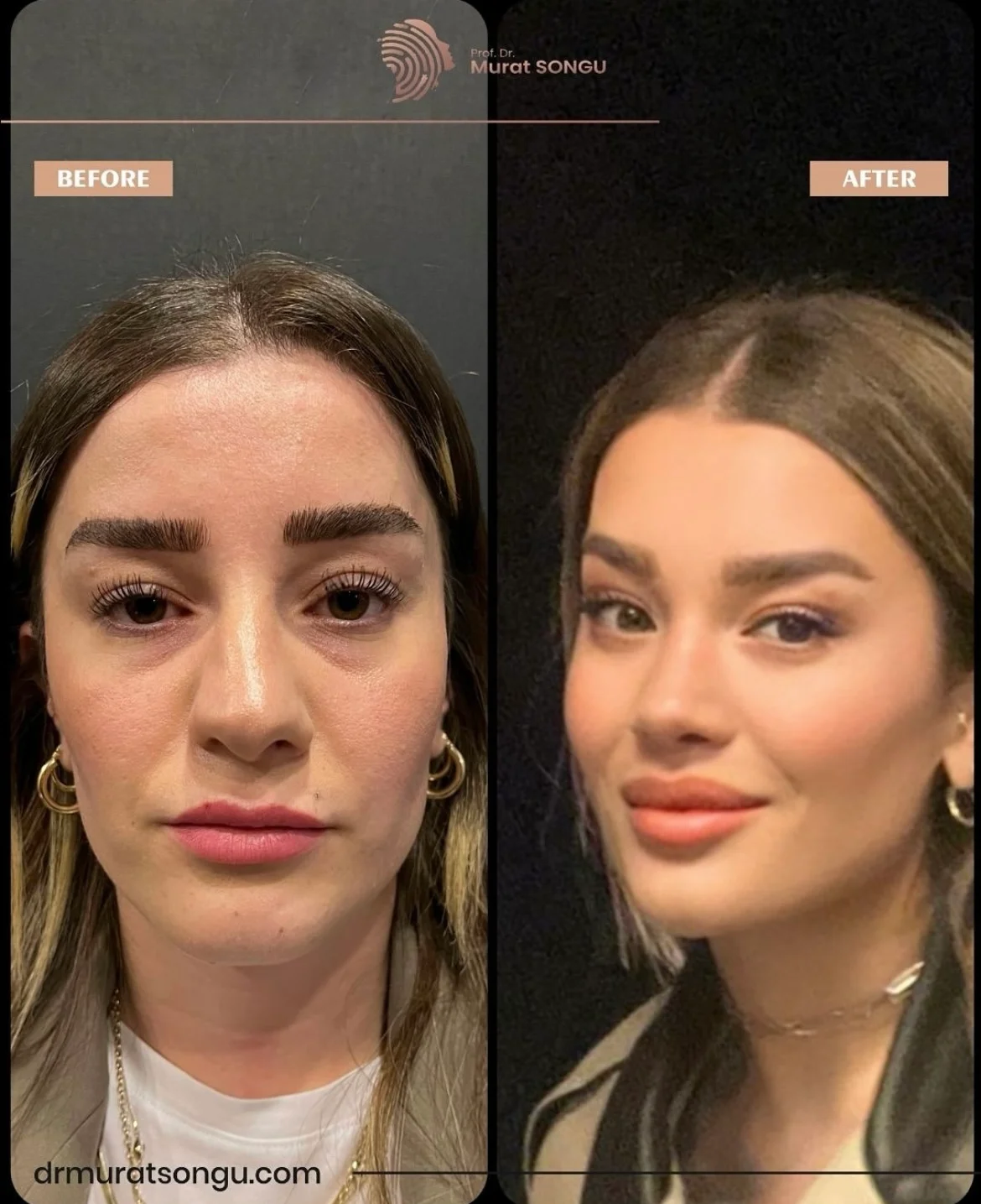 Rhinoplastik Före och Efter Rhinoplastik Före och Efter