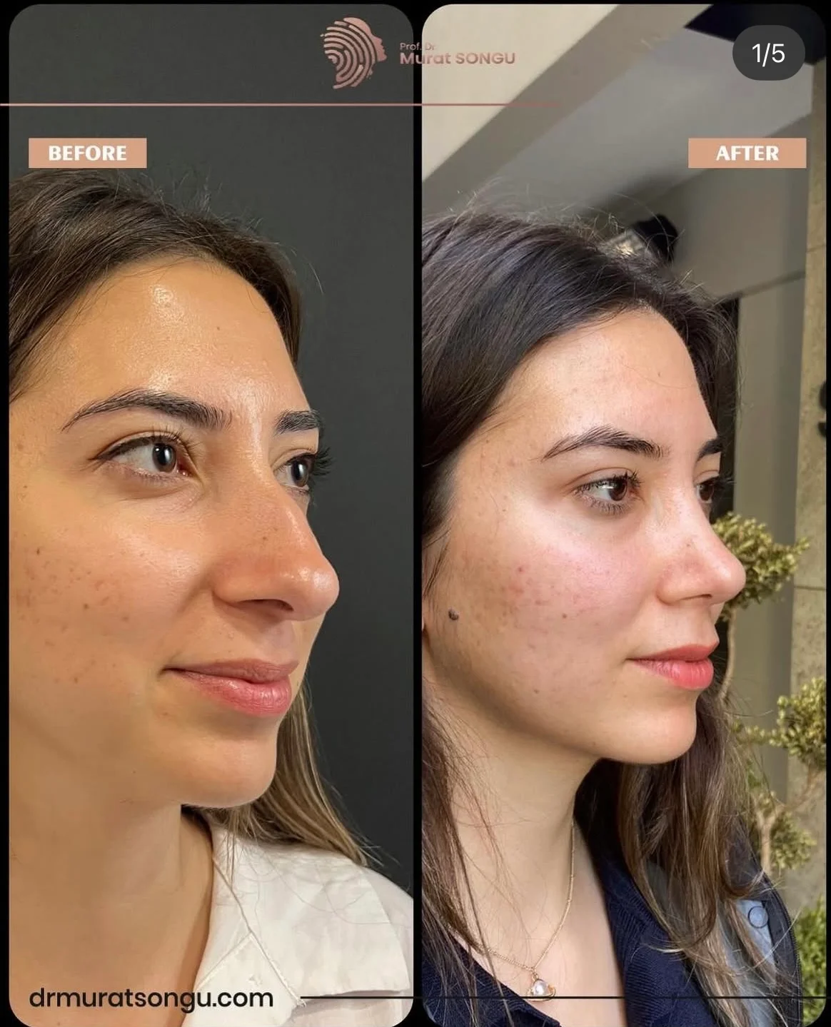 Rhinoplastik Före och Efter Rhinoplastik Före och Efter