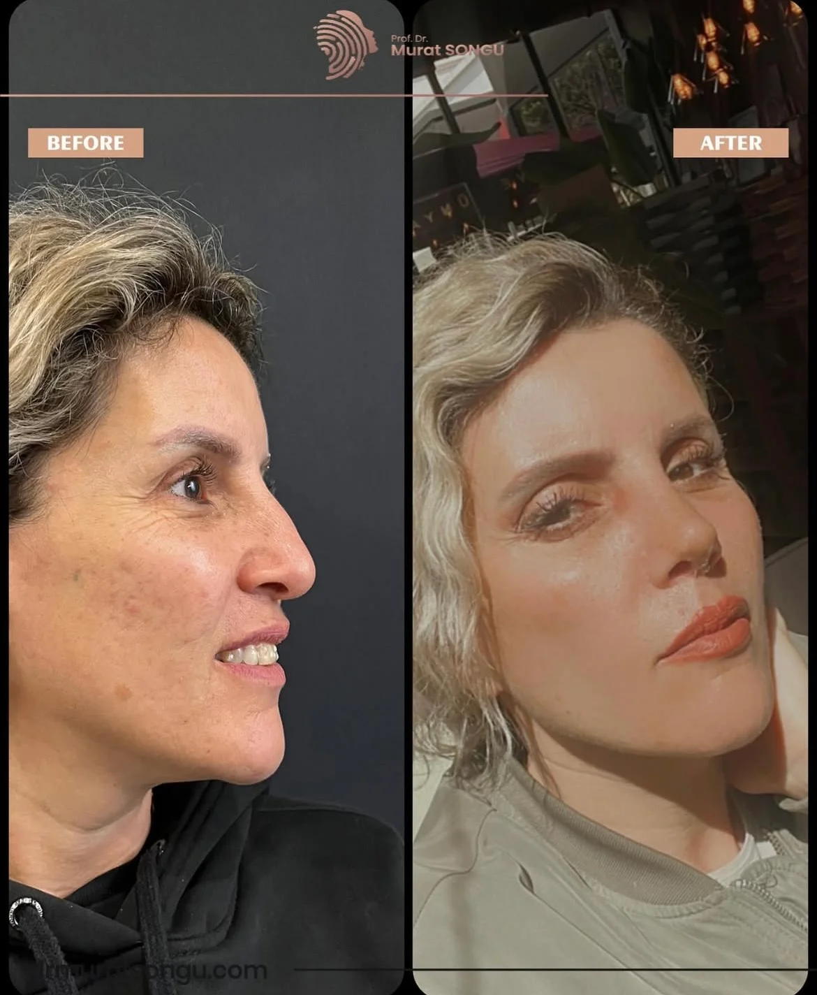 Rhinoplastik Före och Efter Rhinoplastik Före och Efter