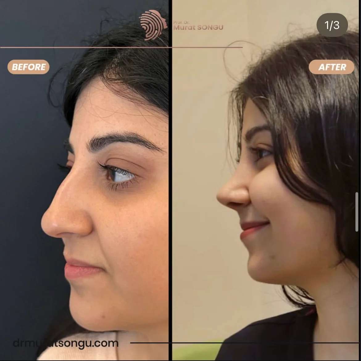 Rhinoplastik Före och Efter Rhinoplastik Före och Efter