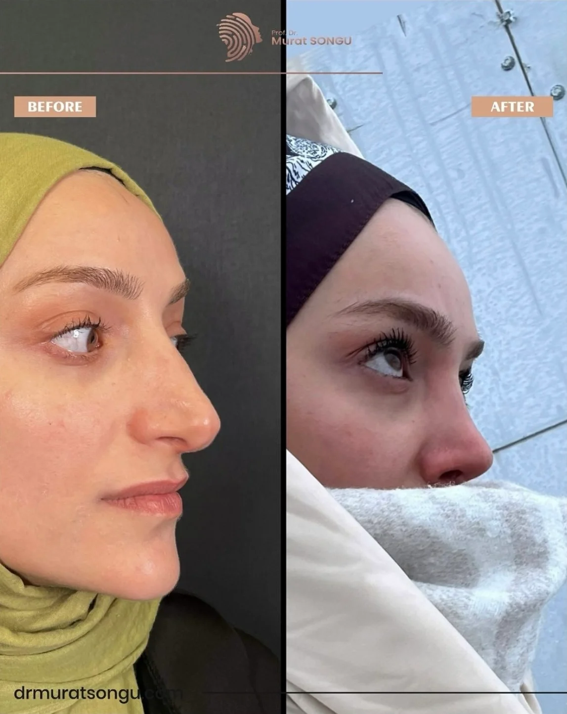 Rhinoplastik Före och Efter Rhinoplastik Före och Efter