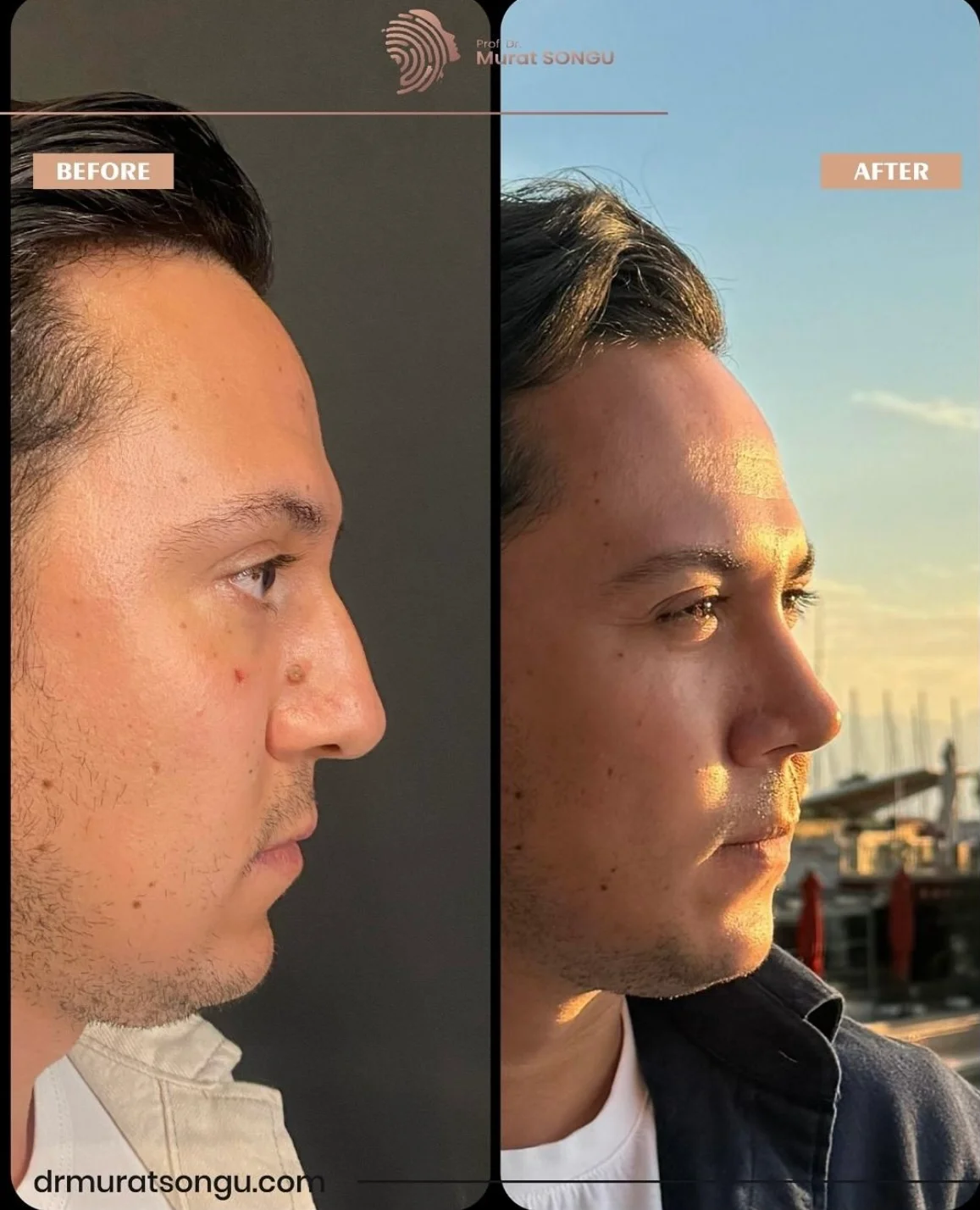 Rhinoplastik Före och Efter Rhinoplastik Före och Efter