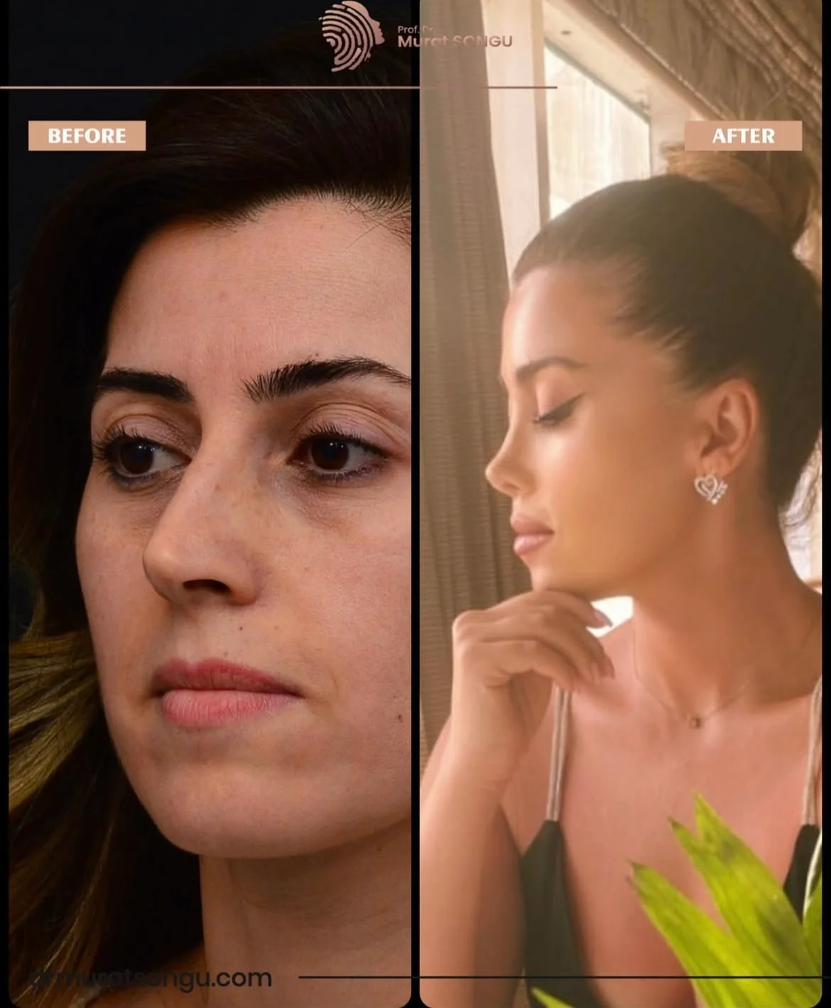 Rhinoplastik Före och Efter Rhinoplastik Före och Efter