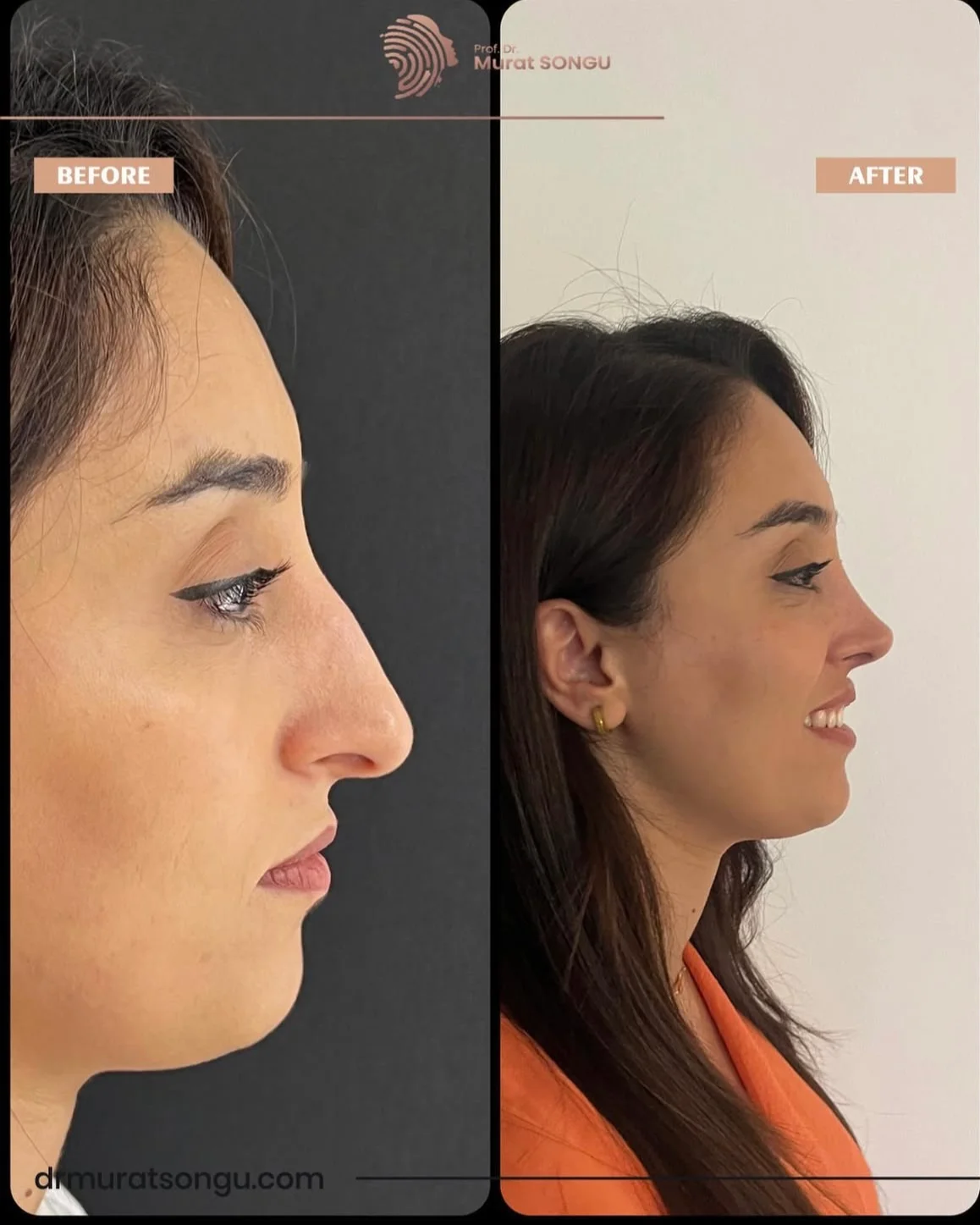 Rhinoplastik Före och Efter Rhinoplastik Före och Efter
