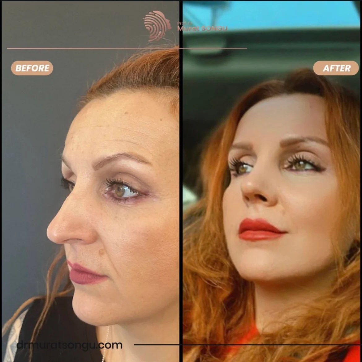 Rhinoplastik Före och Efter Rhinoplastik Före och Efter