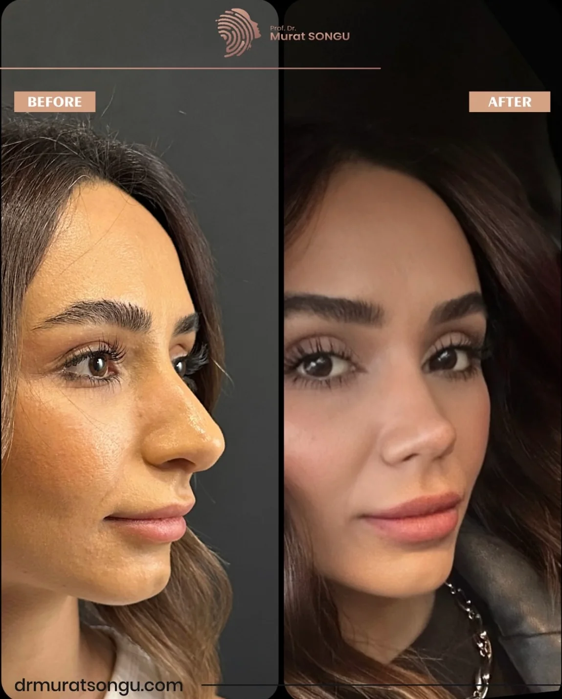 Rhinoplastik Före och Efter Rhinoplastik Före och Efter
