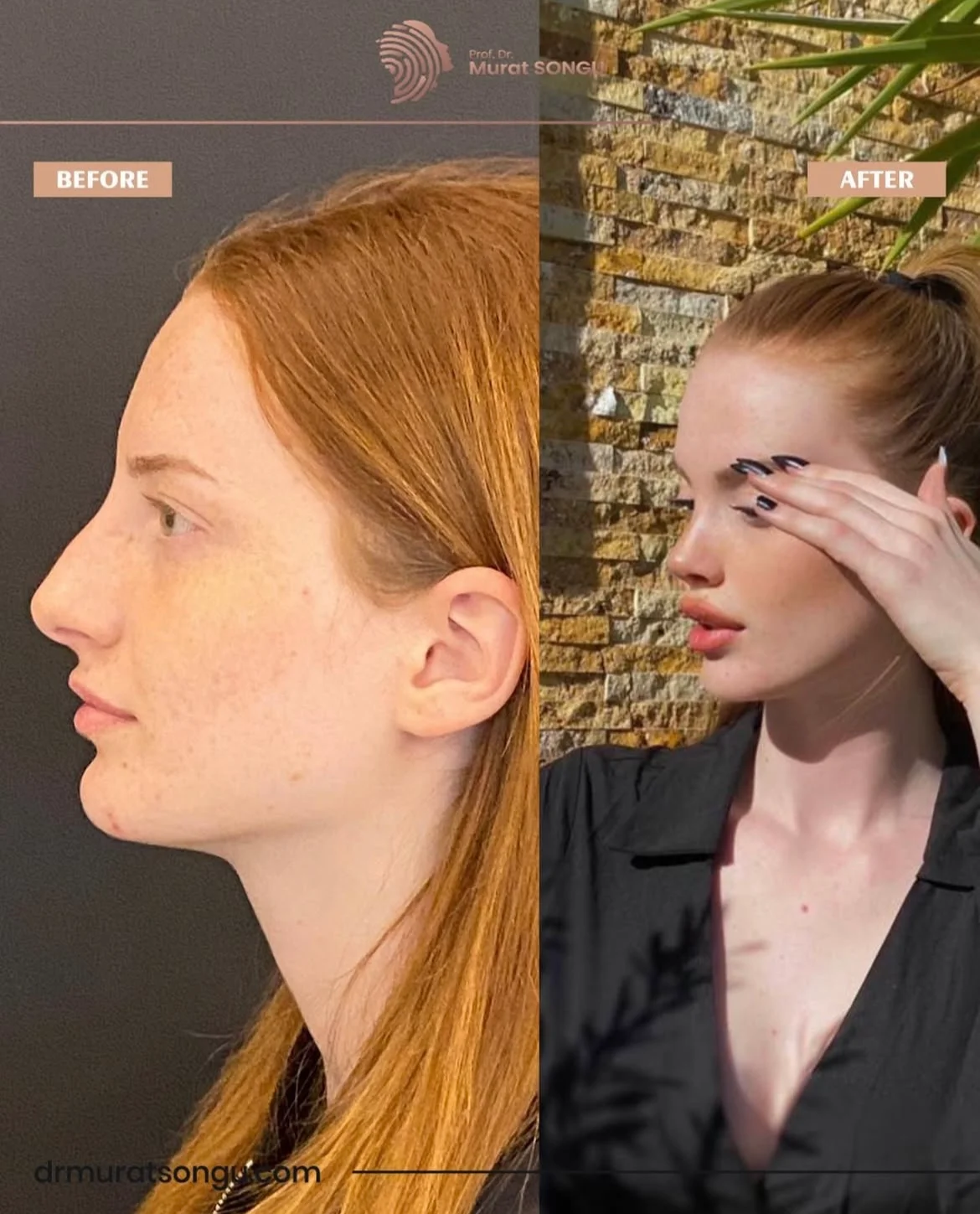 Rhinoplastik Före och Efter Rhinoplastik Före och Efter