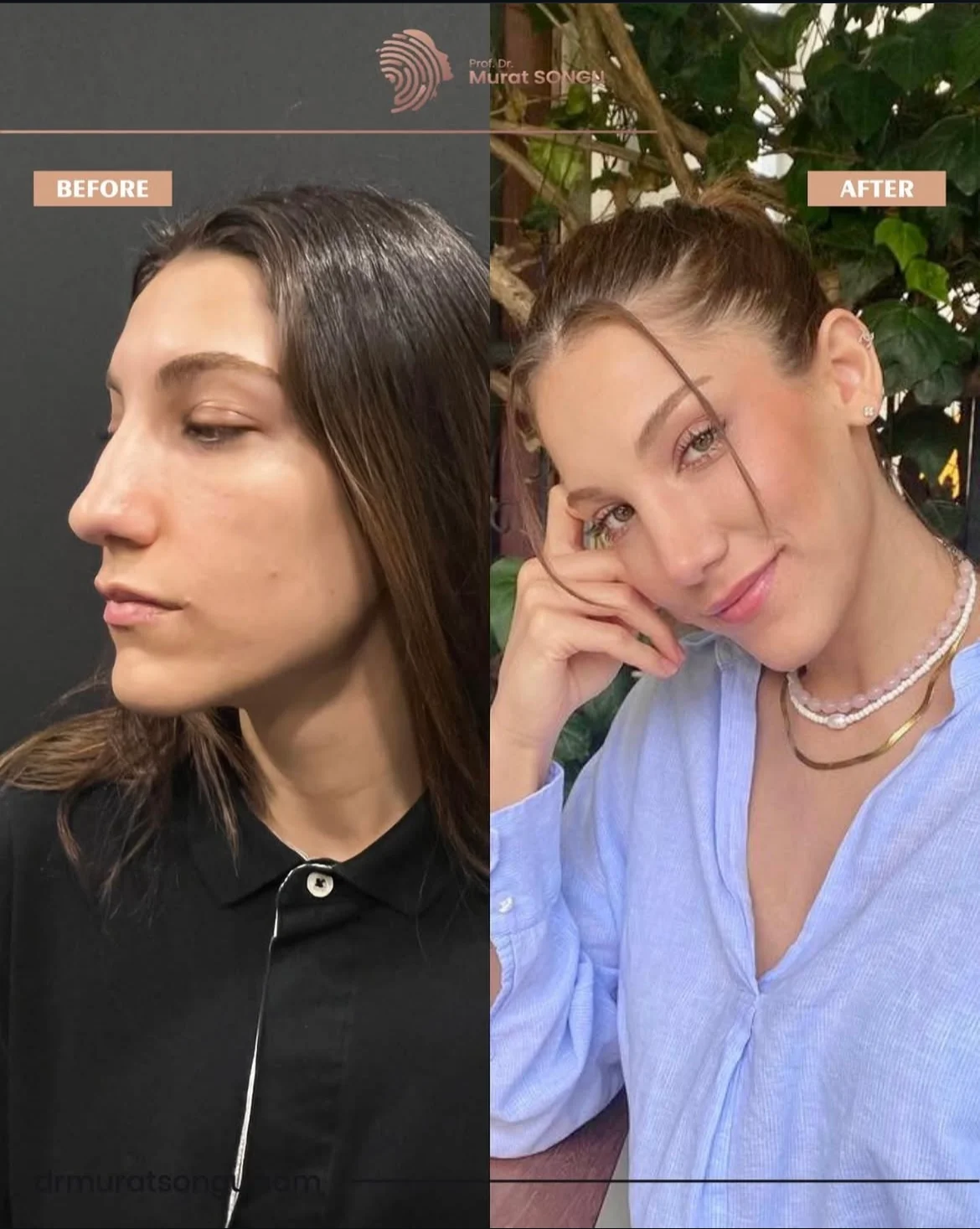 Rhinoplastik Före och Efter Rhinoplastik Före och Efter