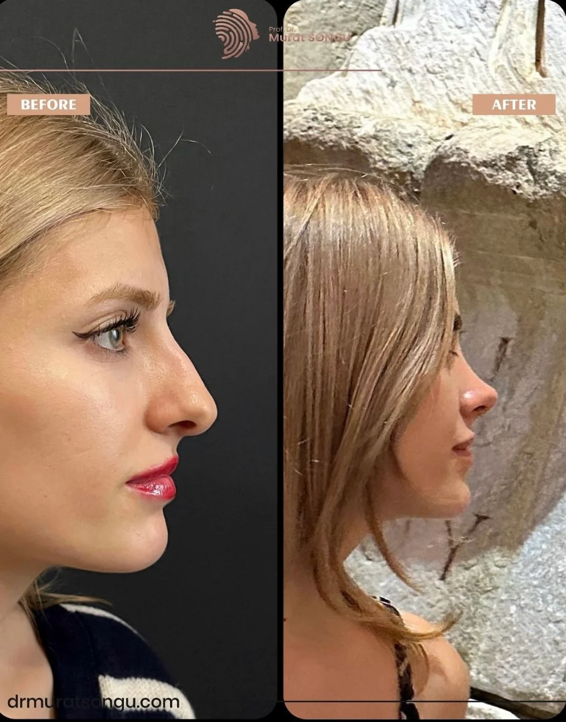 Rhinoplastik Före och Efter Rhinoplastik Före och Efter