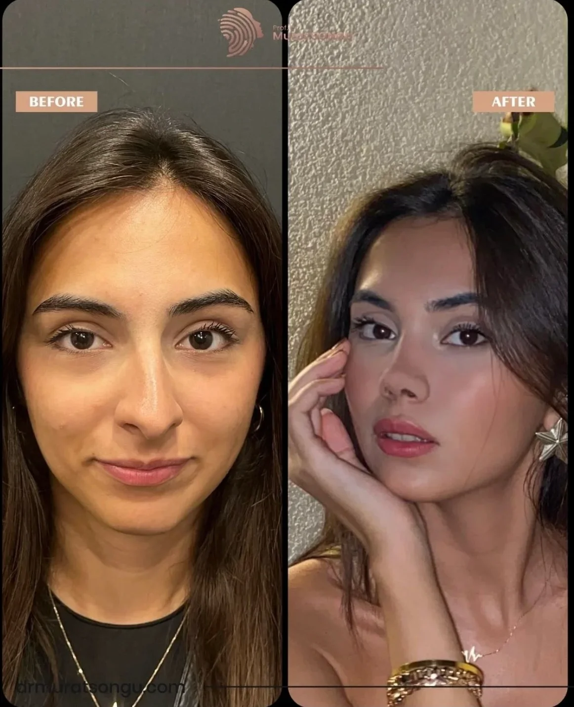 Rhinoplastik Före och Efter Rhinoplastik Före och Efter